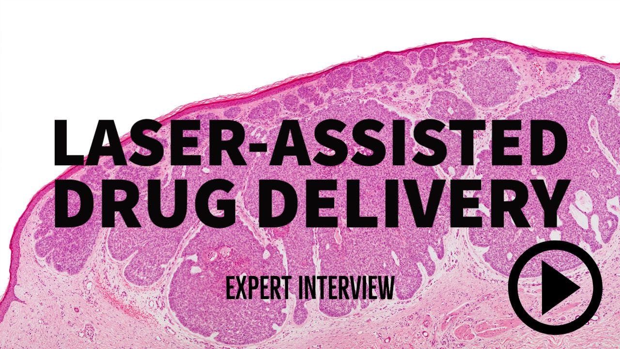 laser-assisted drug delivery