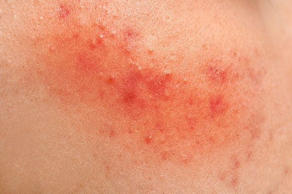 Doxycycline plus topical effective for severe acne