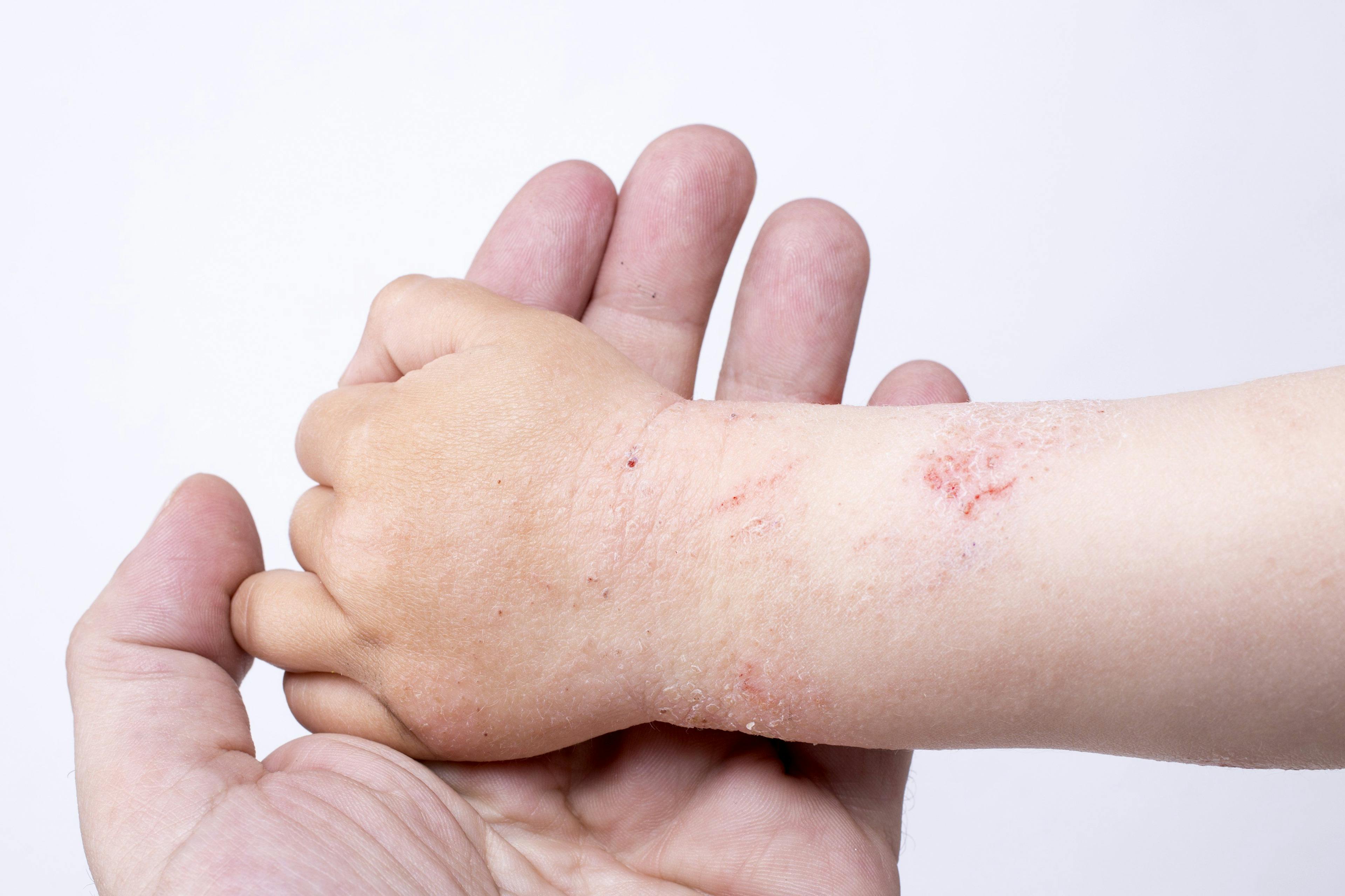 Person holding child's hand which shows red, irritated skin