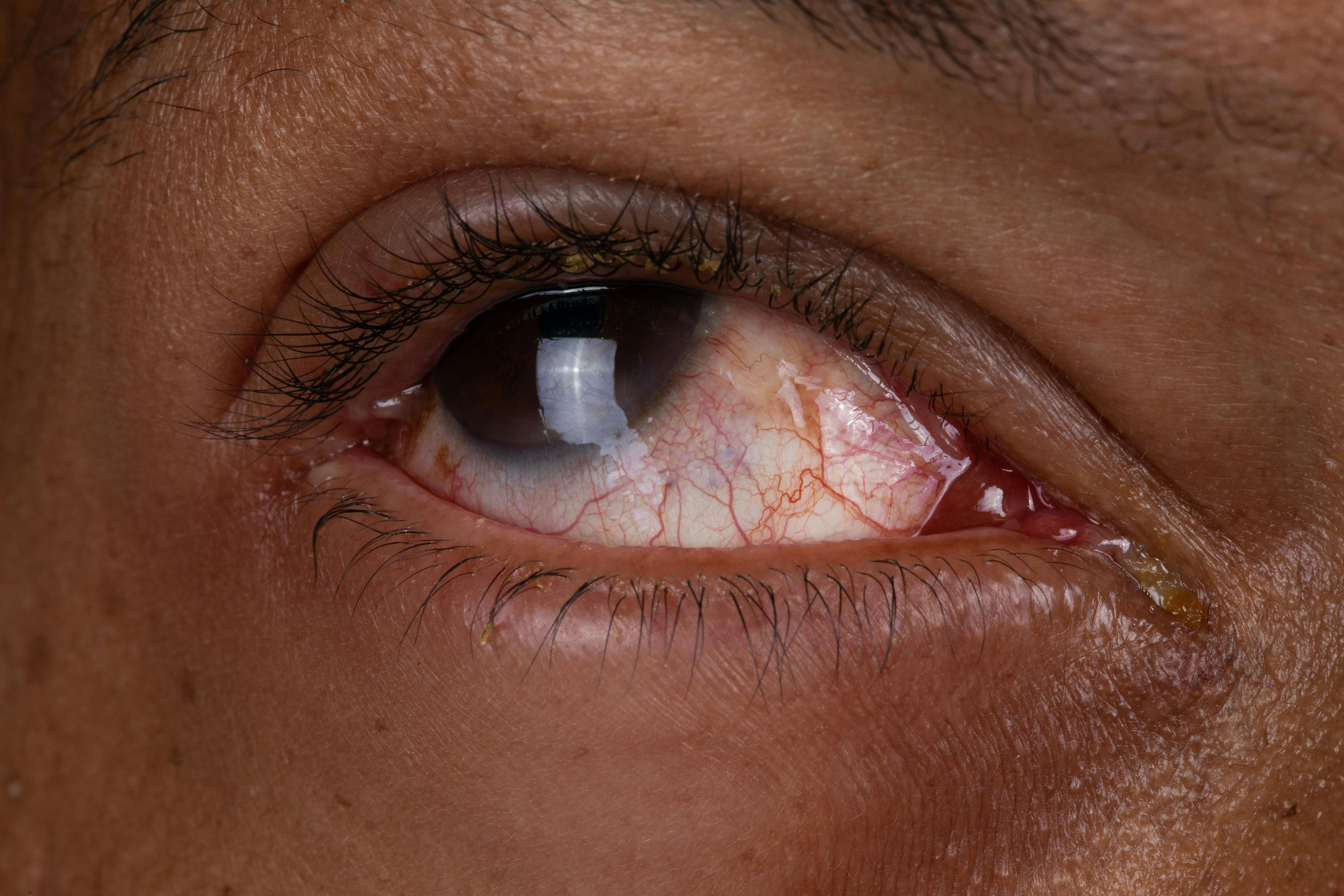 NEJM Publishes Data on the Application of B-VEC to Treat Ocular Complications in Patients with DEB  