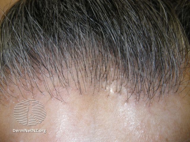 Frontal fibrosing alopecia

Image courtesy of DermNet