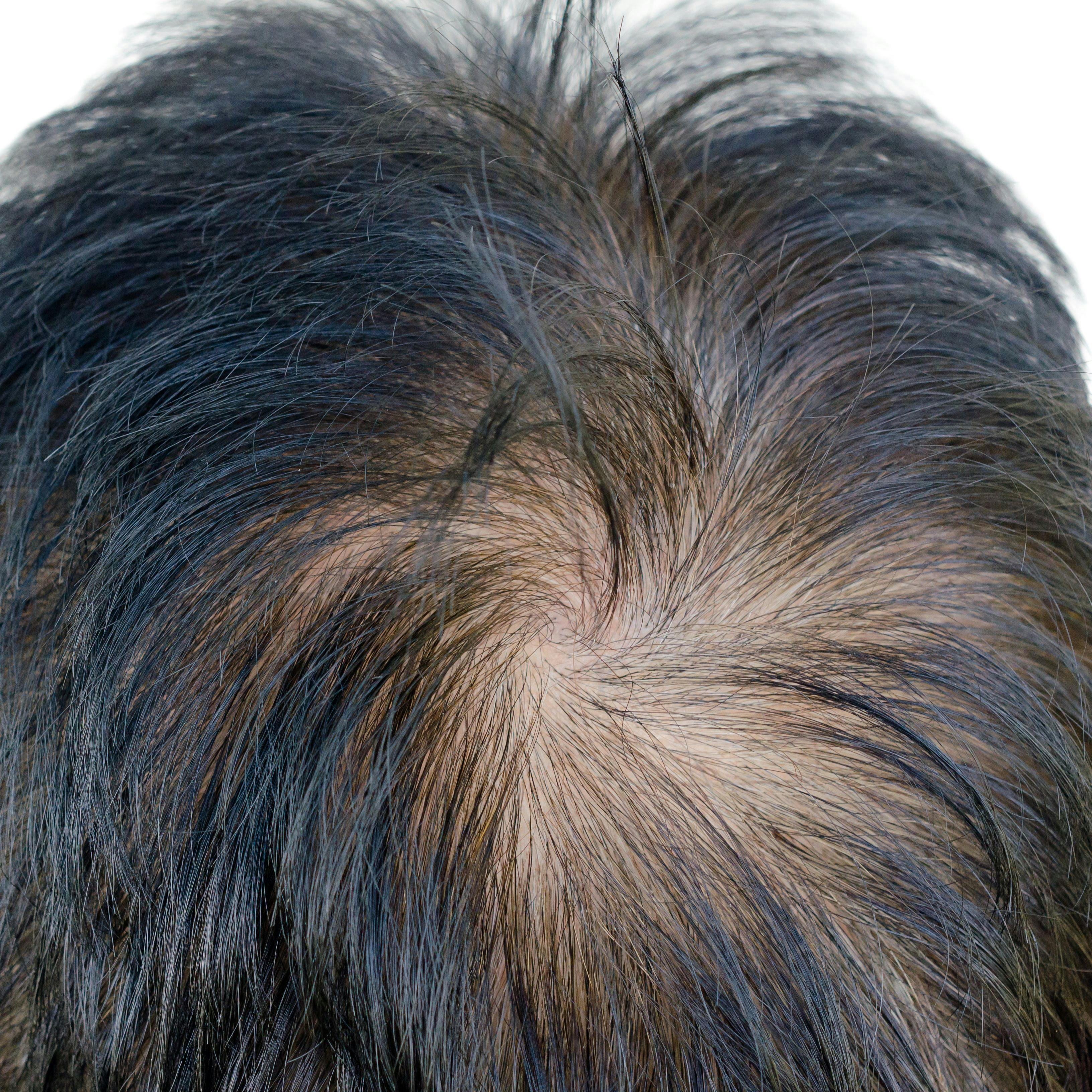Minoxidil Combined With Laser Treatment Improves Hair Condition in Androgenetic Alopecia
