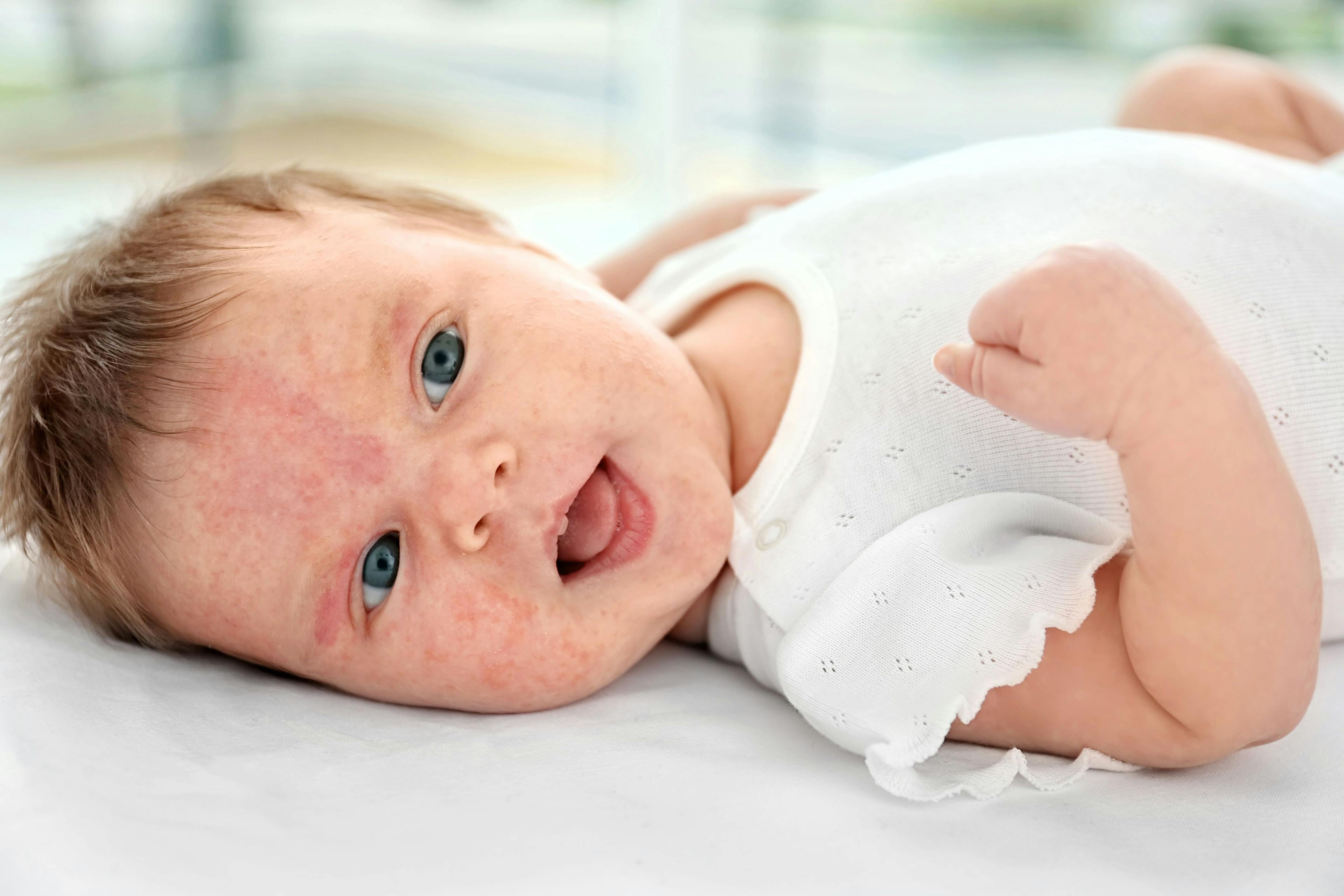 New Study Finds Skin Immune Biomarker Test Helps Predict Eczema in Babies 