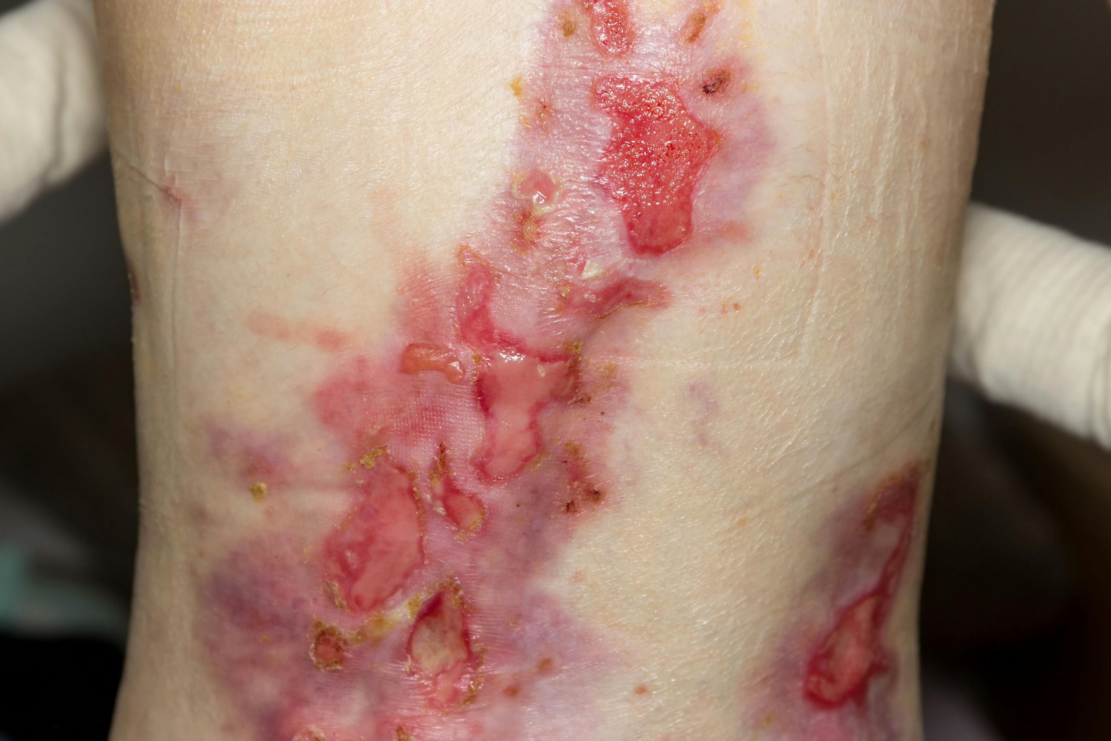 Autologous Cell Therapy Effective in Wound Treatment