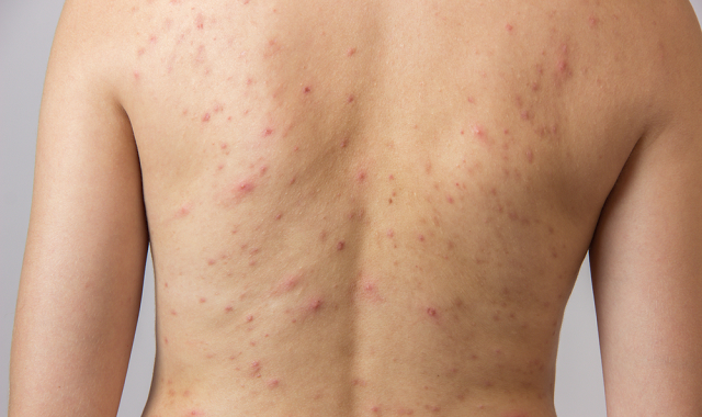 Dapsone gel may prove viable in truncal acne