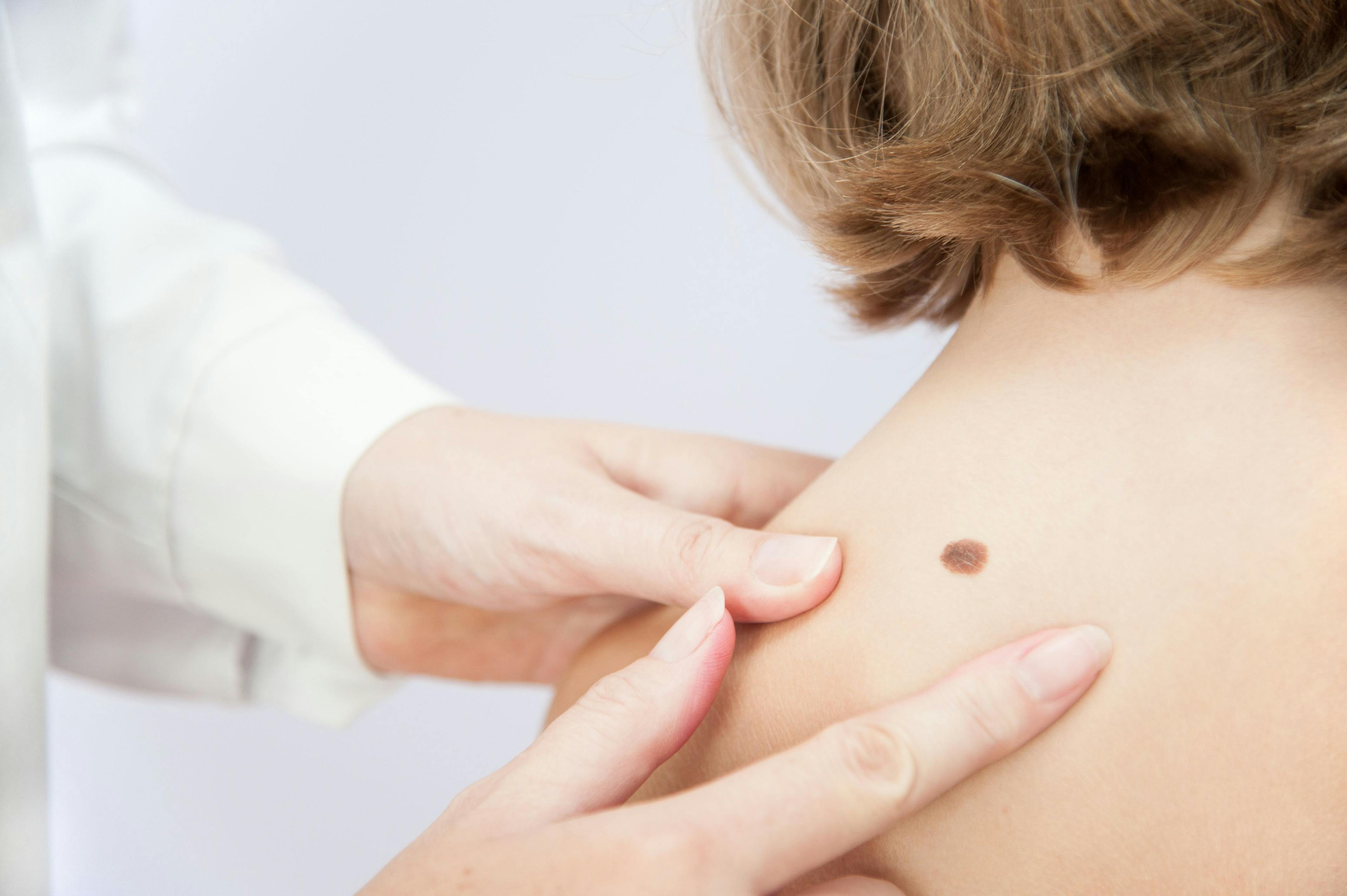 POLL: Do you educate your patients about skin cancer?