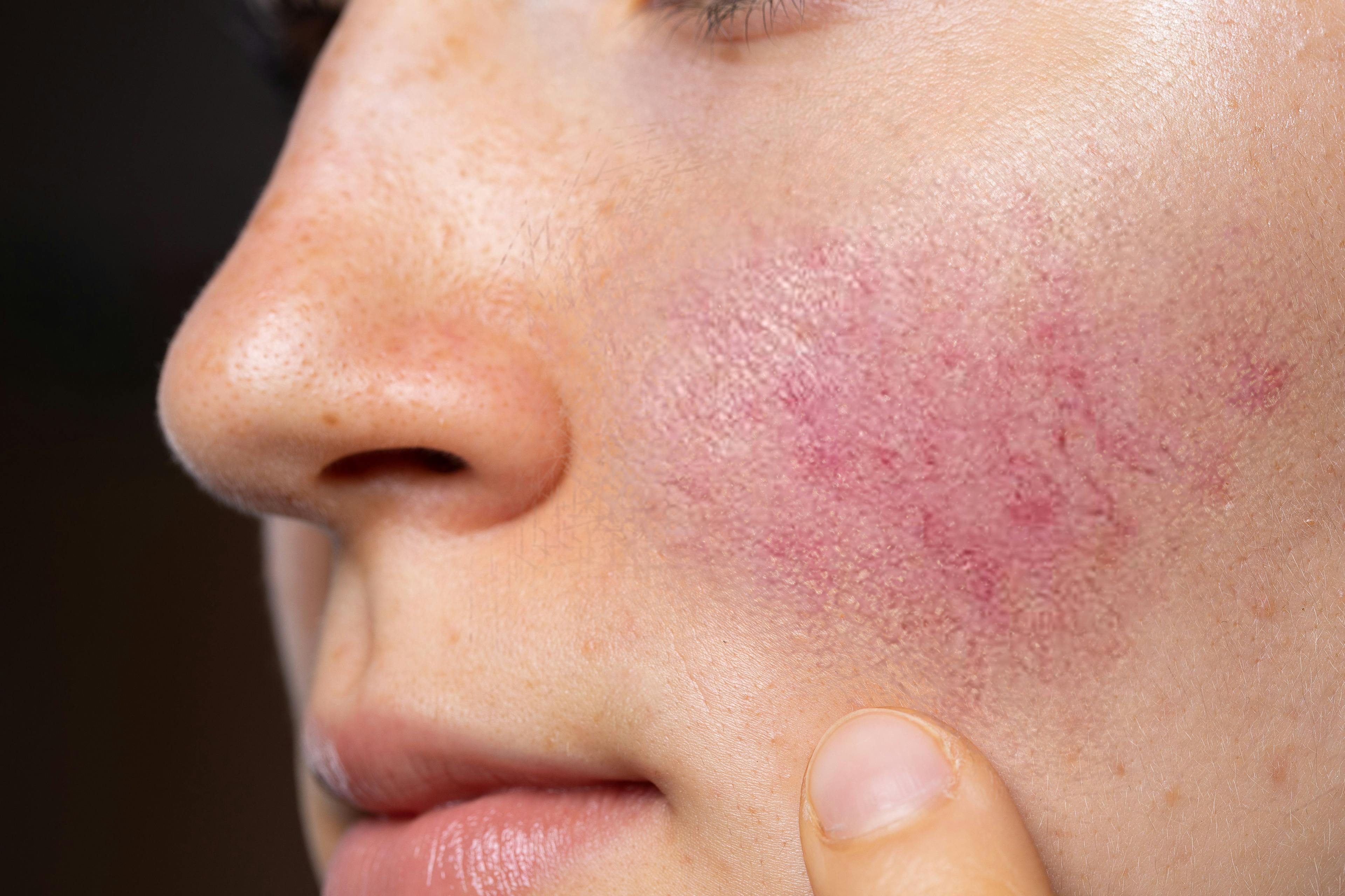 QUIZ RECAP: Test Your Knowledge of Rosacea Etiology, Types, and Triggers