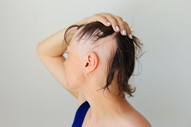 Experts Review Key Factors in Alopecia Areata Severity and Morbidity Index, Treatment Decisions