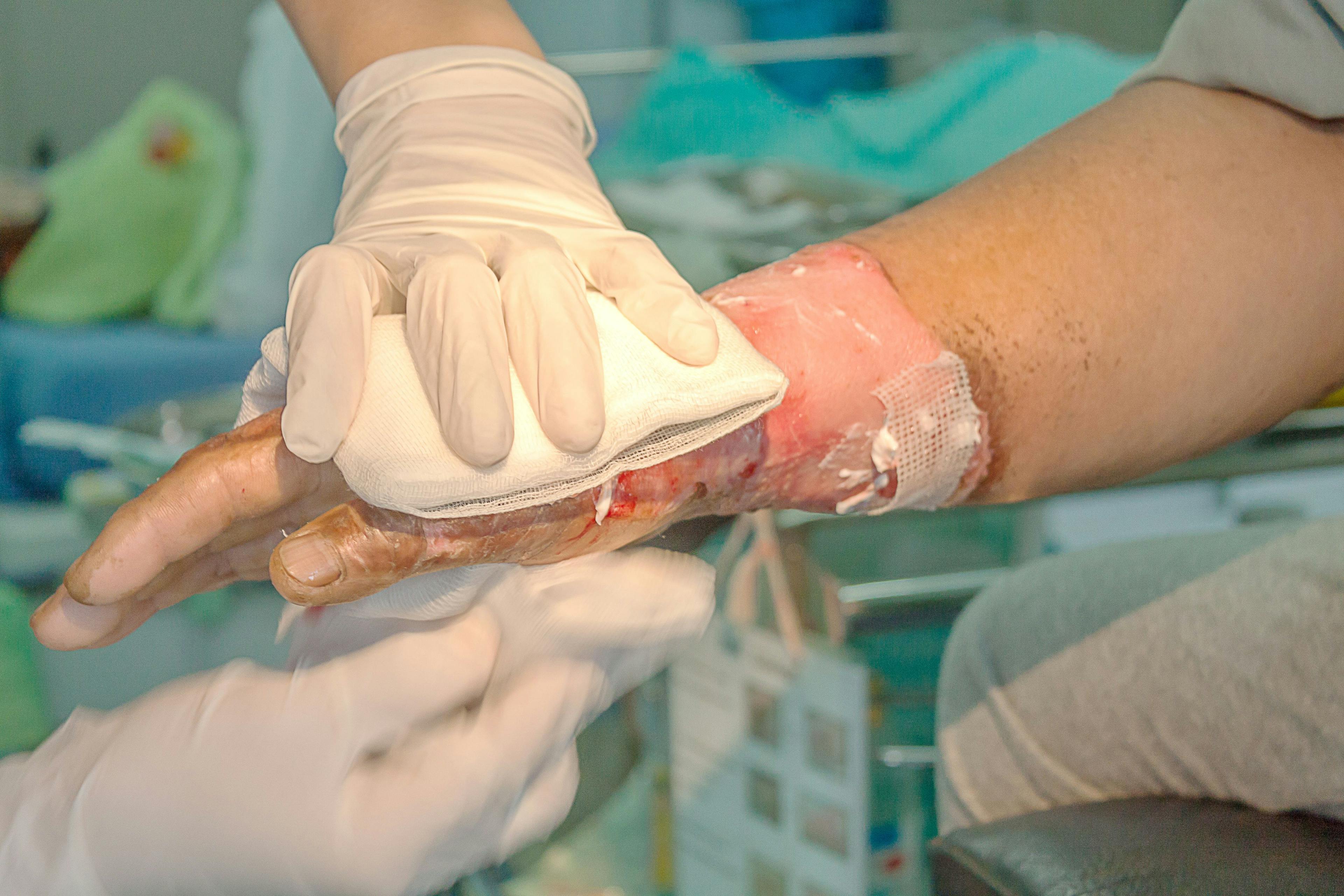 FDA Accepts BLA for NexoBrid to Treat Severe Burns