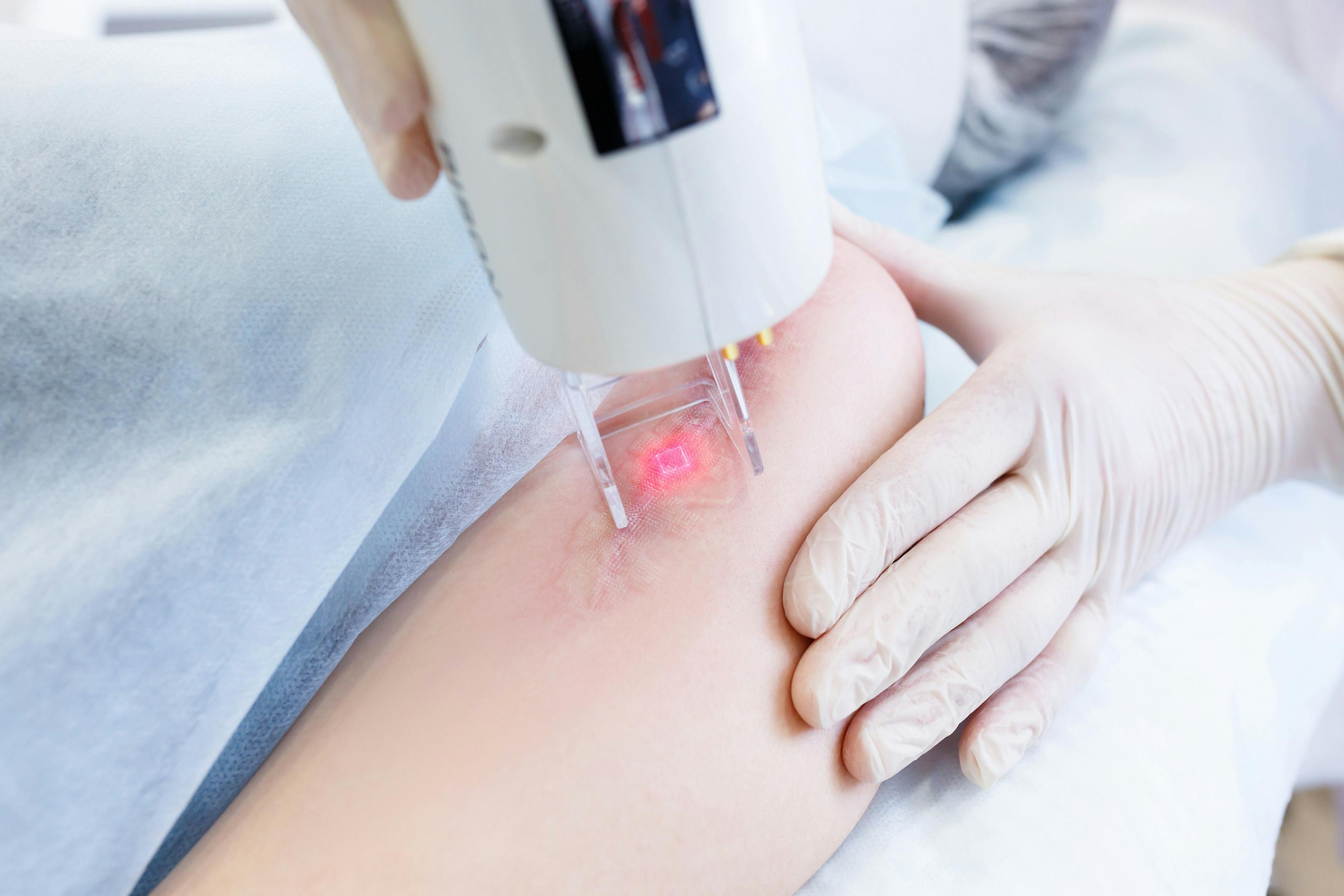 Nonablative Lasers Offer a Gentle Approach to Healthy Skin