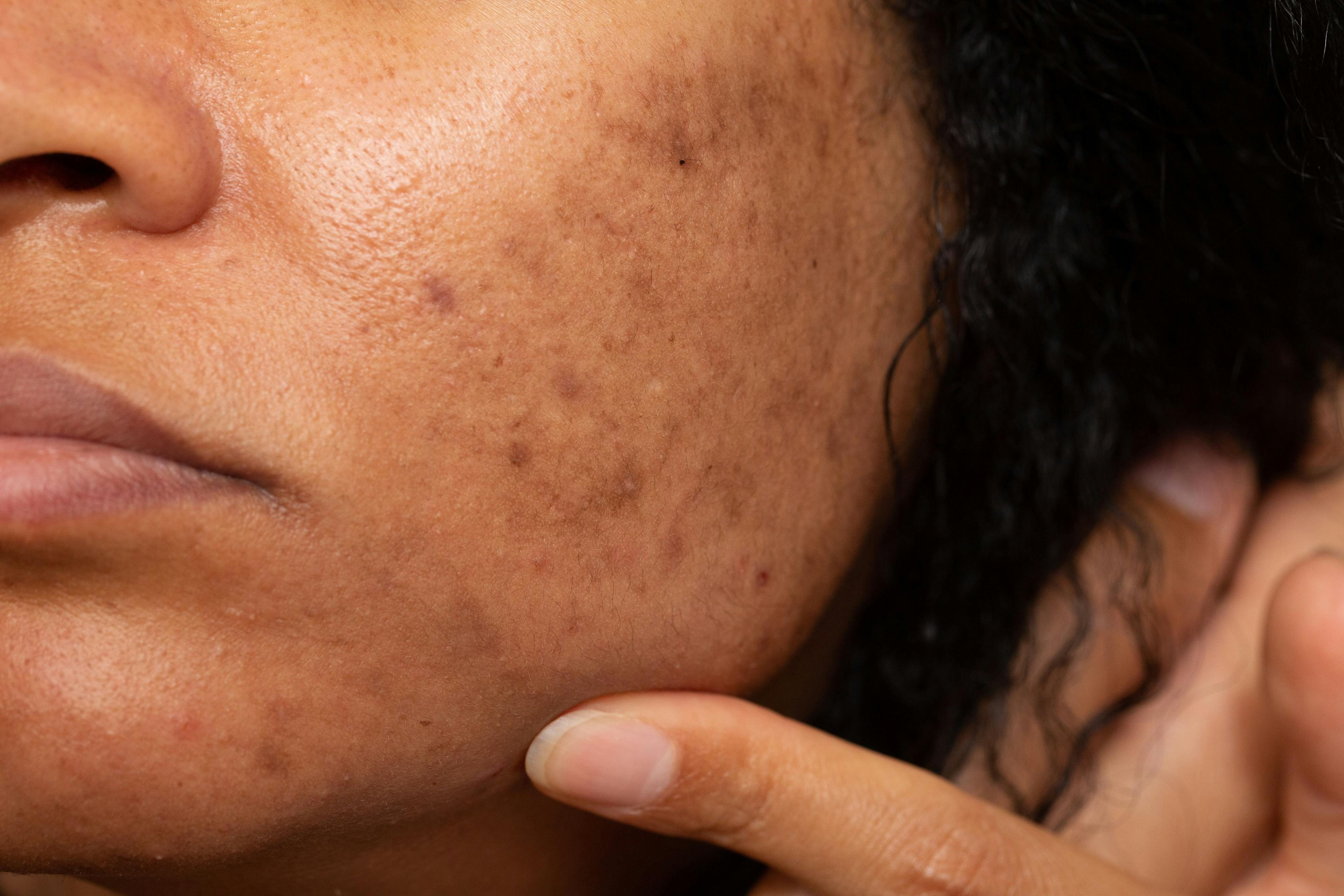 Reviewing Common Facial, Bodily Pigmented Dermatoses in Varying Clinical Presentations