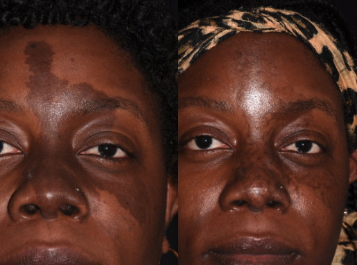 42-year-old Black woman with café au lait birthmark before and after 1 treatment with 1064-nm picosecond laser (Lumenis).