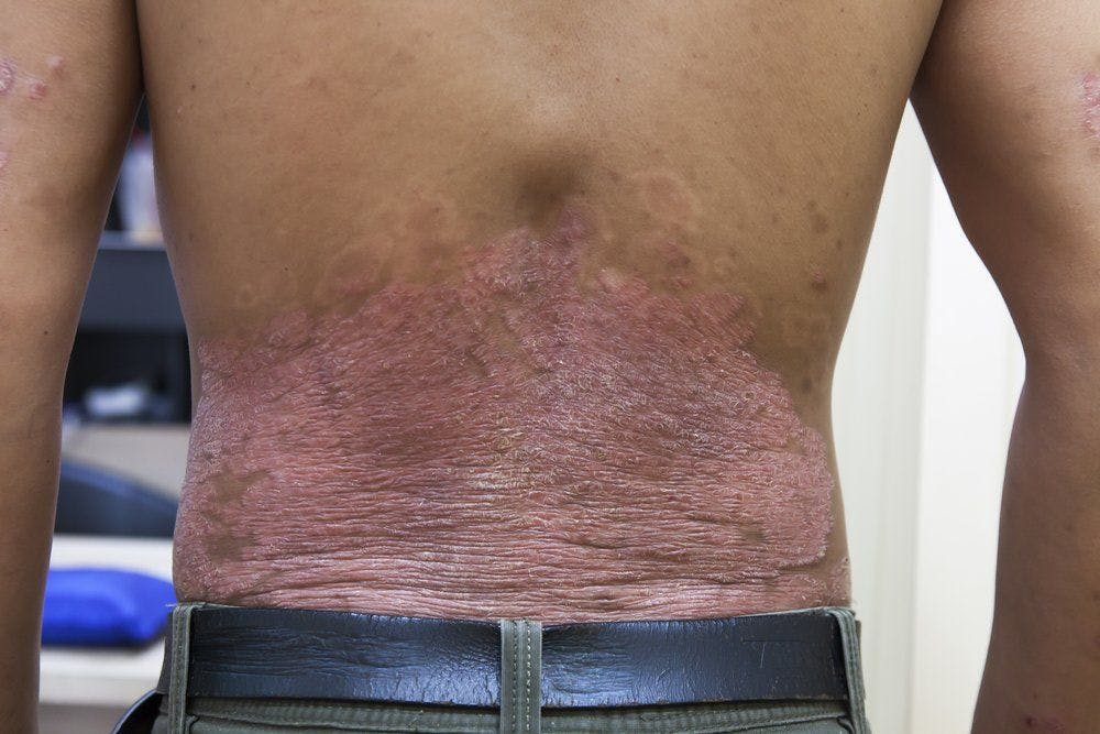 Nonsteroidal Treatment Options for Plaque Psoriasis