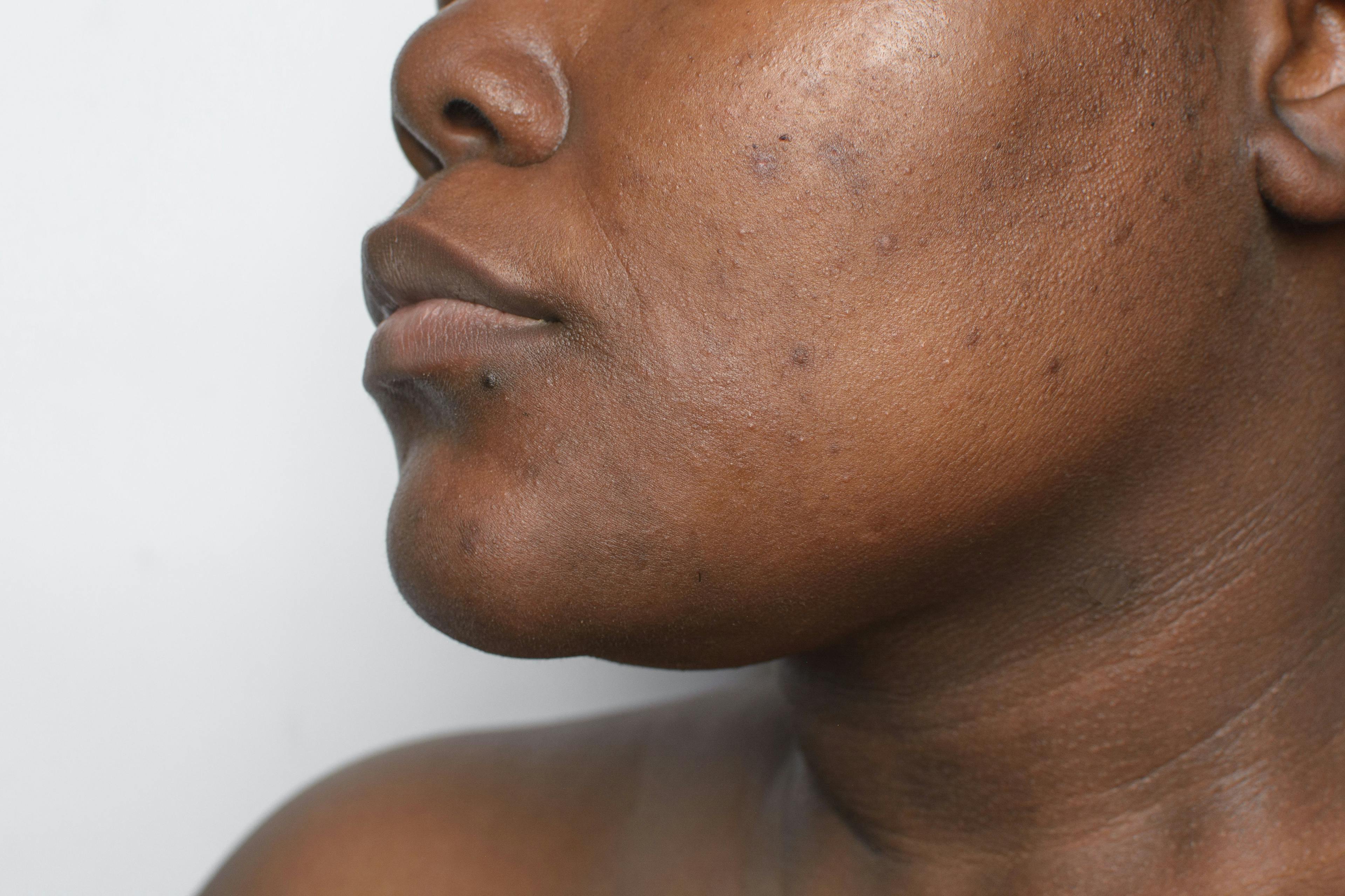 Treating and Preventing Postinflammatory Hypo- and Hyperpigmentation