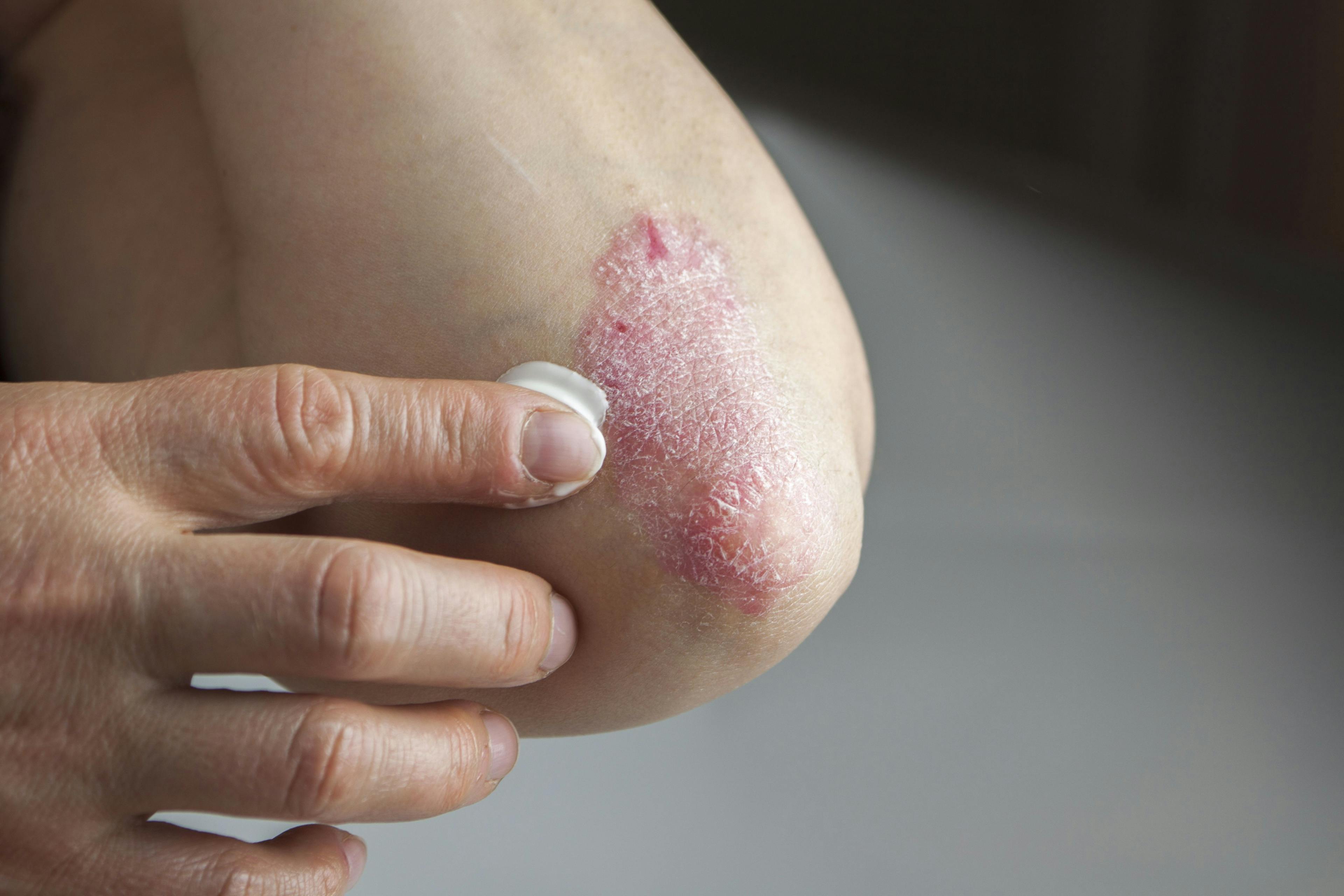 Survey: Emotional Impact of Psoriasis Highlights Needs for New Treatments