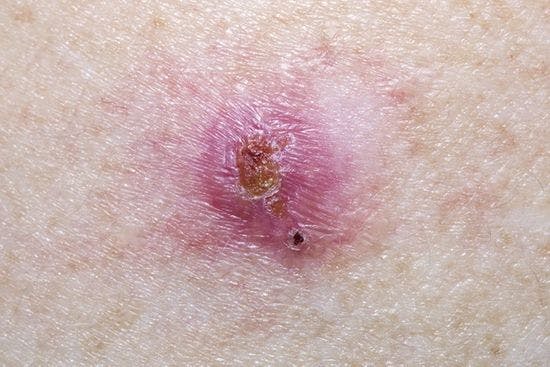 Basal Cell Carcinoma on a mature female