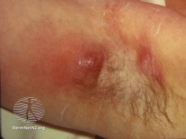 Hidradenitis suppurativa of axilla

Image courtesy of DermNet