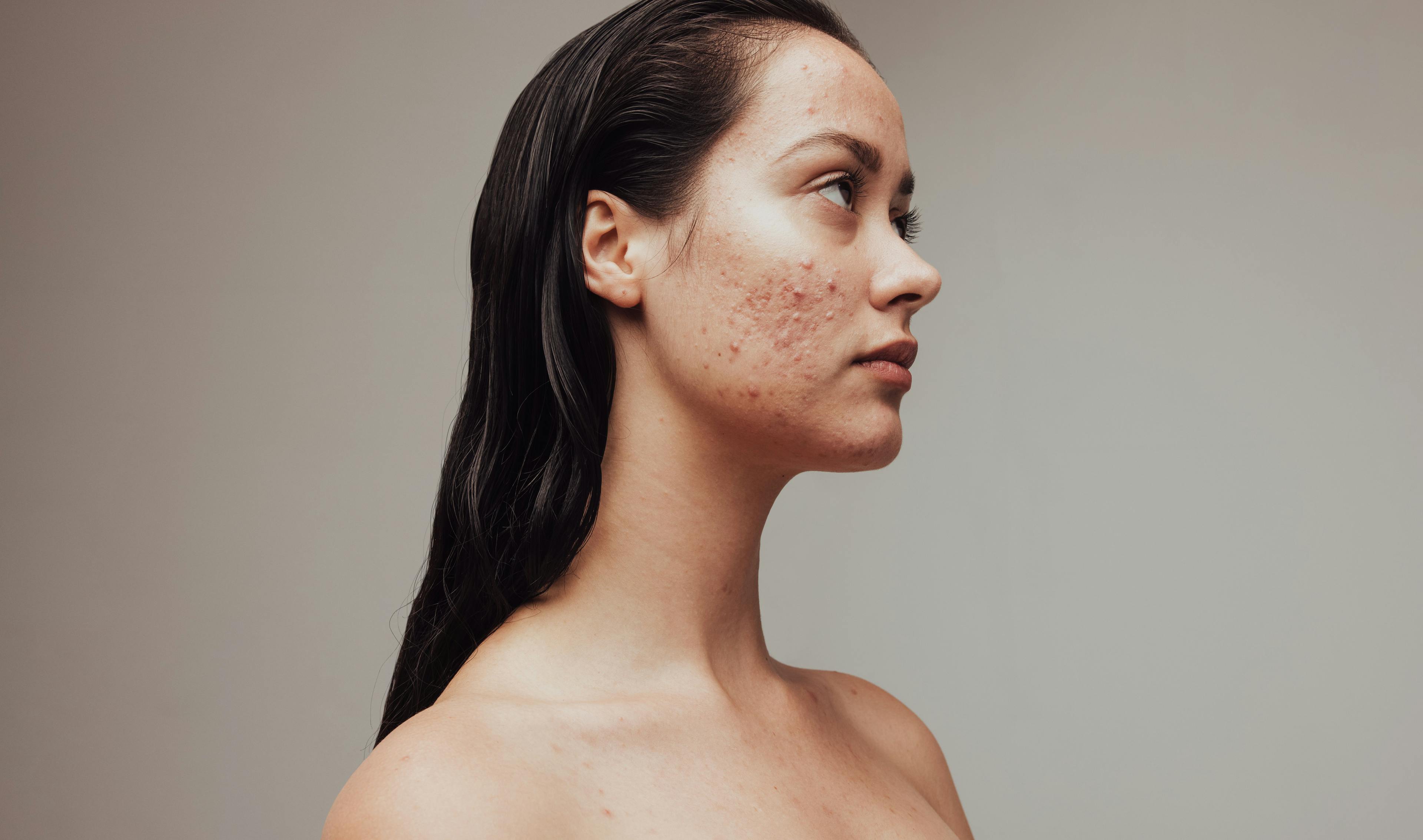Research Finds Dermatology Visits for Acne Higher in Adult Female Patients