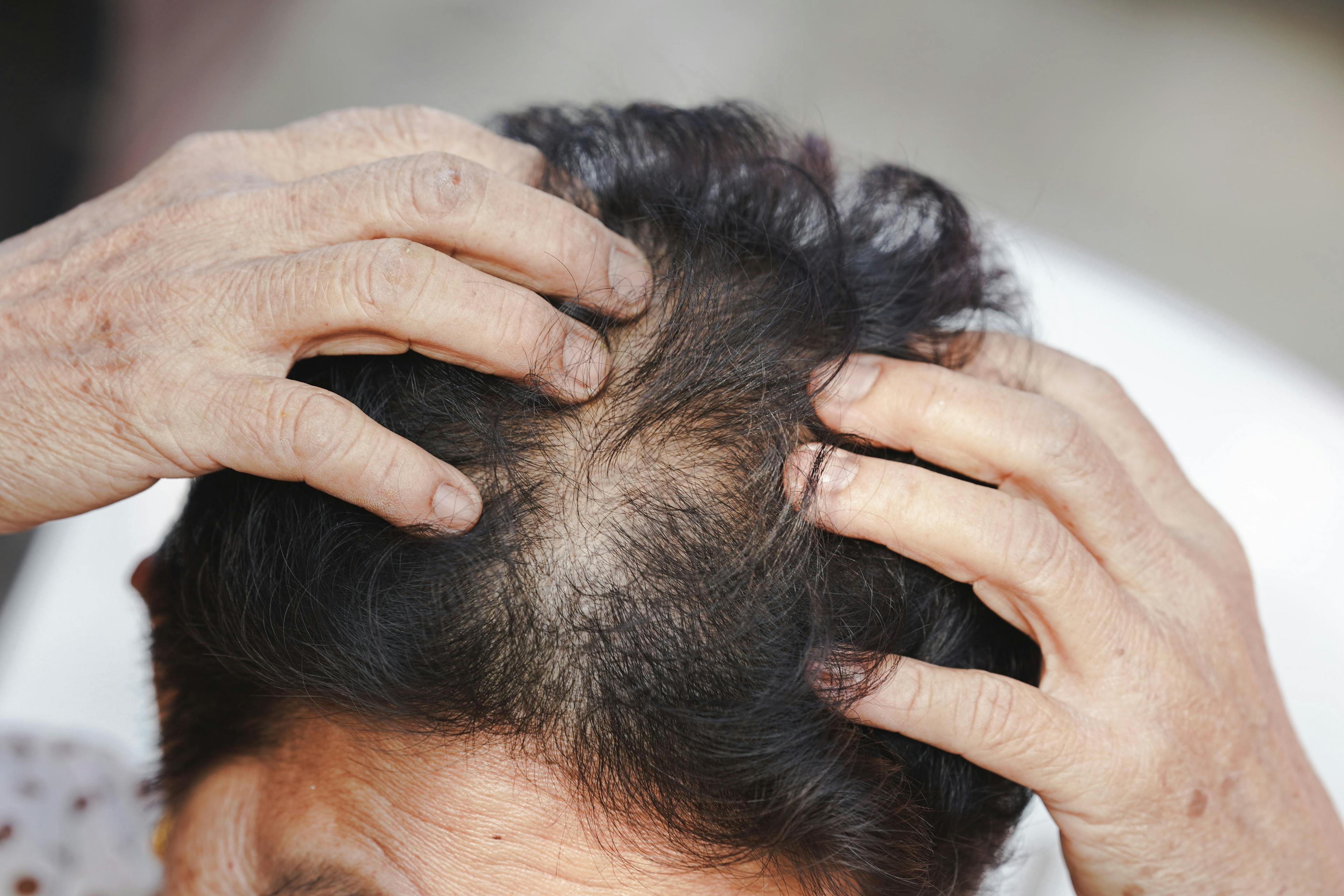Low-Dose Oral Minoxidil for Hair Growth