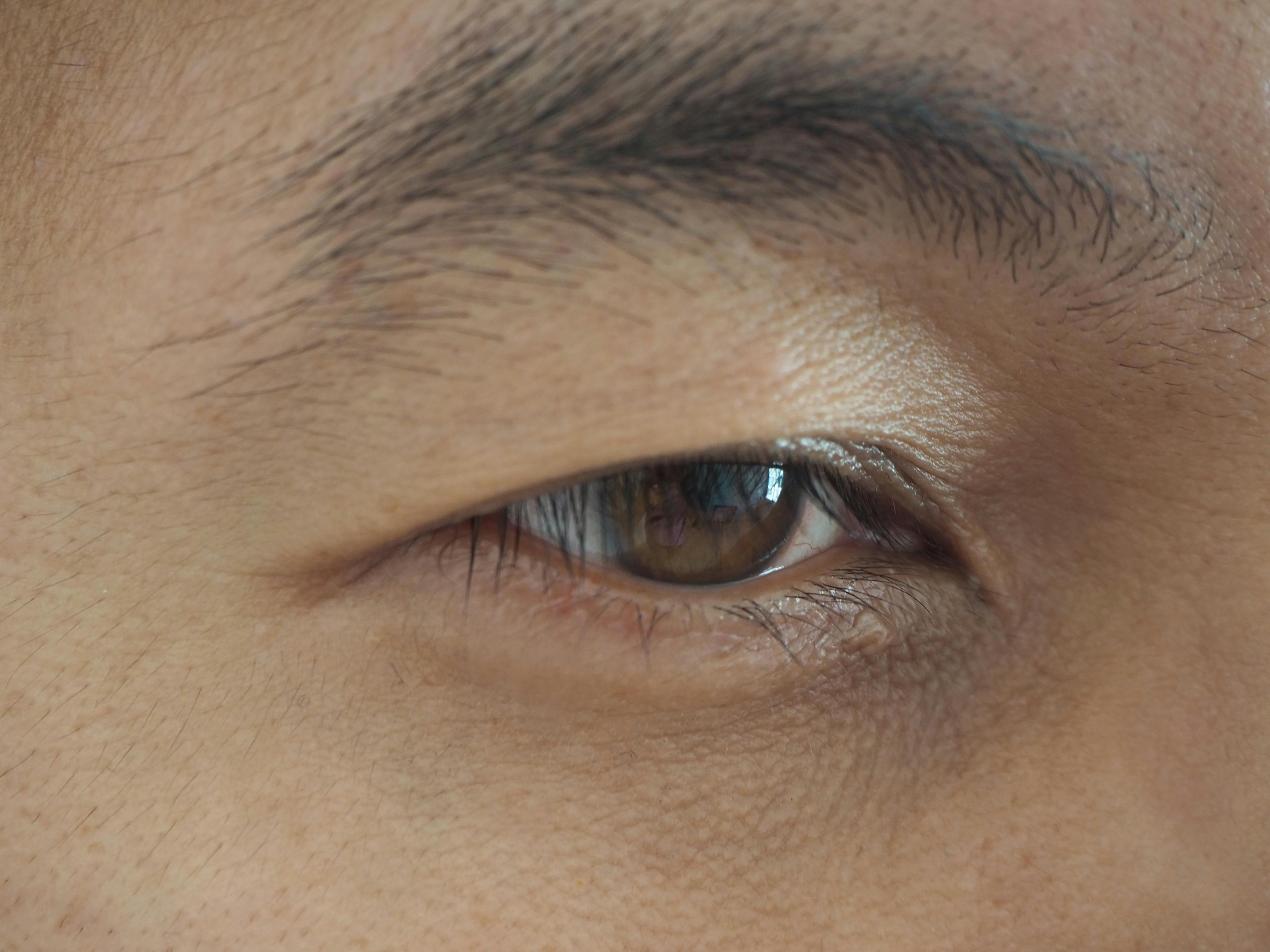  Is the Double-Incision Eyelid Surgery Effective?