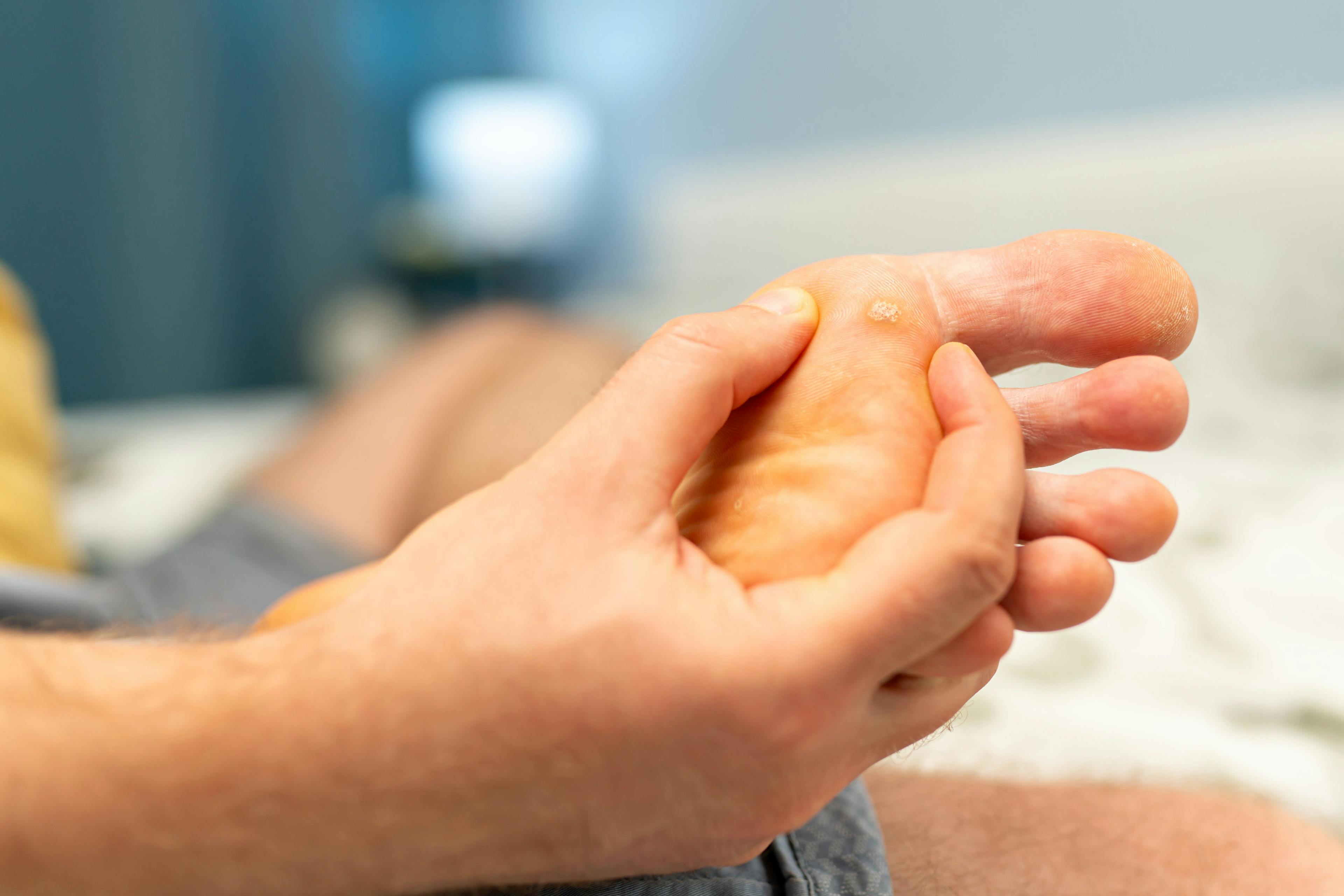 Is CPS the Solution for Refractory Plantar Warts? 