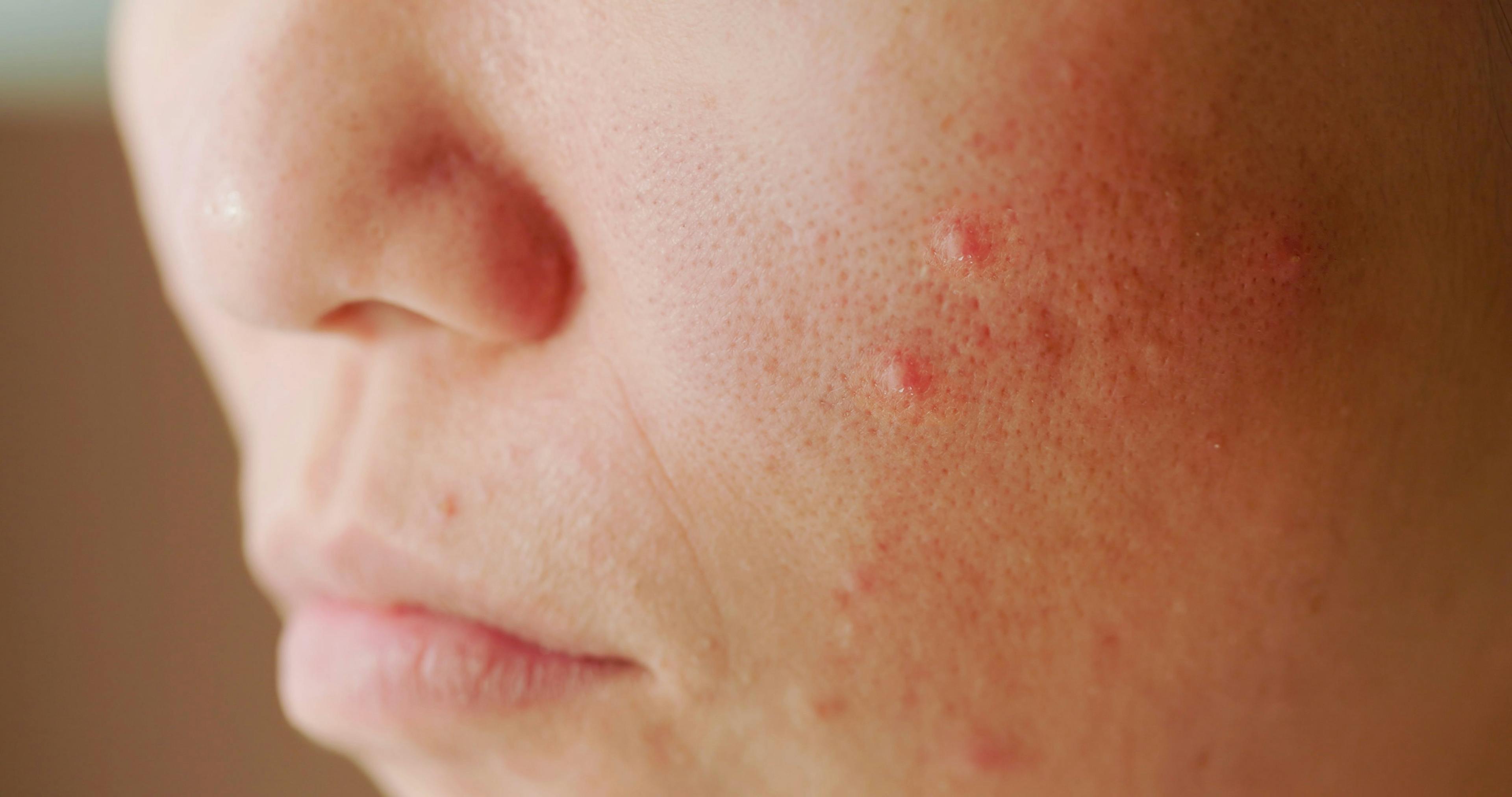 Study: Acne a Common Side Effect of Atopic Dermatitis Treatment
