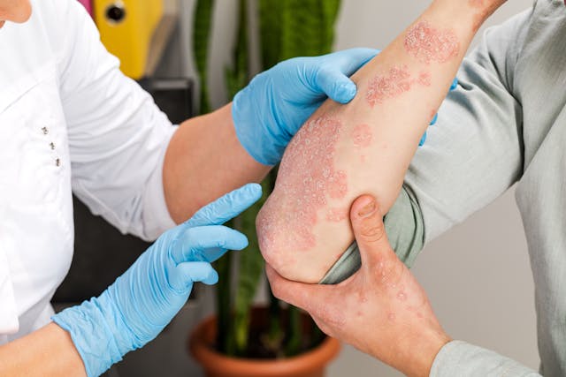 SARS-CoV-2 Associated With Increased Incidence of Psoriasis