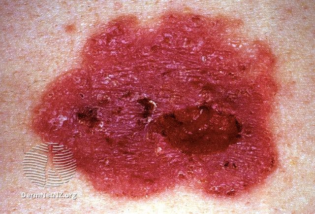 Basal cell carcinoma

Image courtesy of DermNet