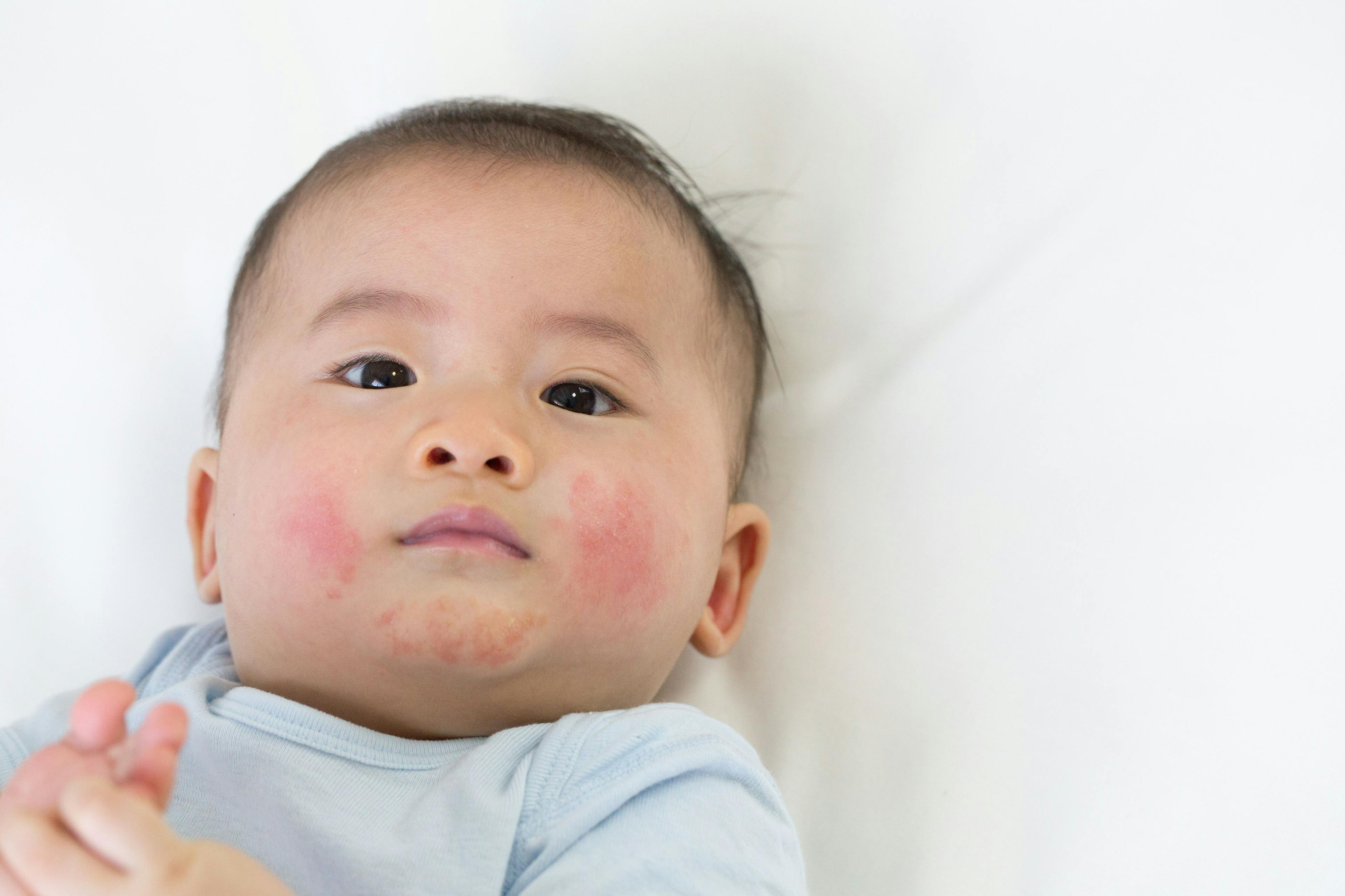 RNA Monitoring Offers Non-Invasive Detection of Infantile Atopic Dermatitis