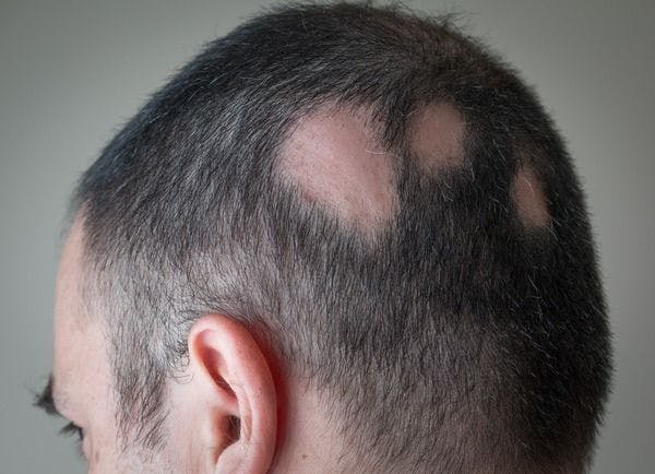 close up of spot baldness in a patient with alopecia areata