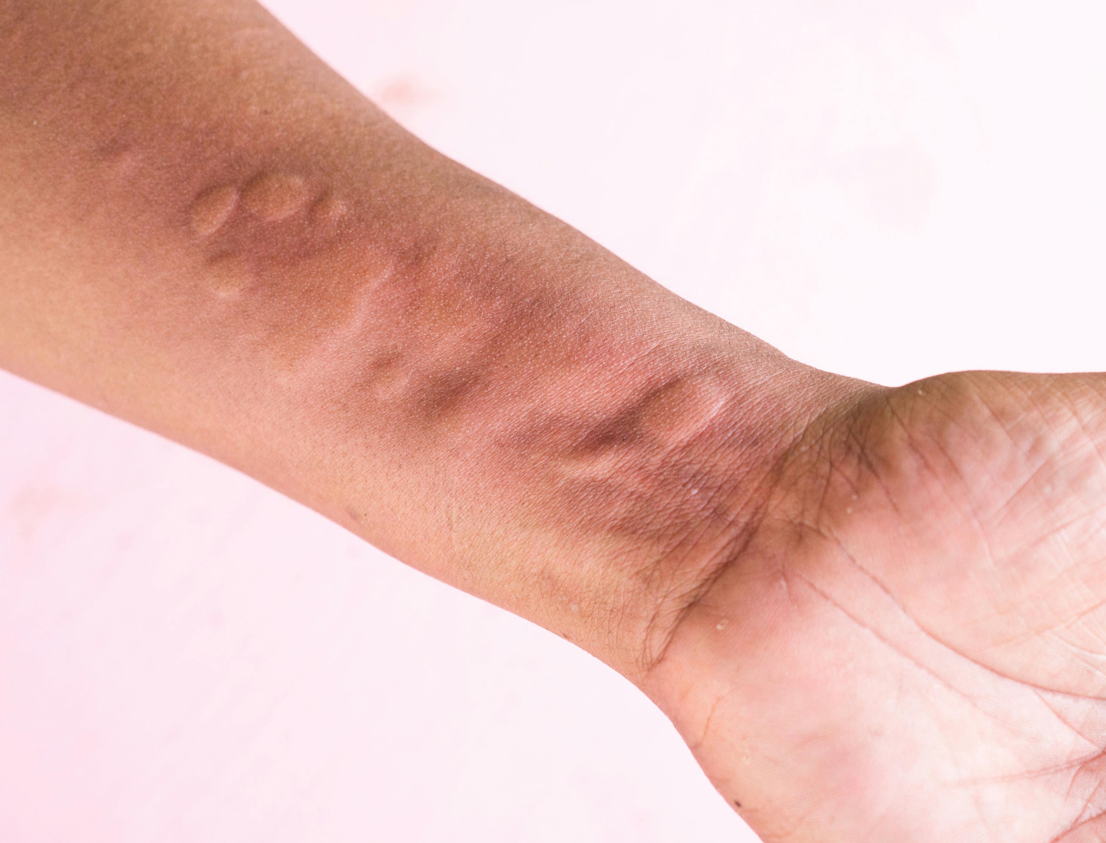 FDA Issues Complete Response Letter for Dupilumab sBLA for Chronic Spontaneous Urticaria