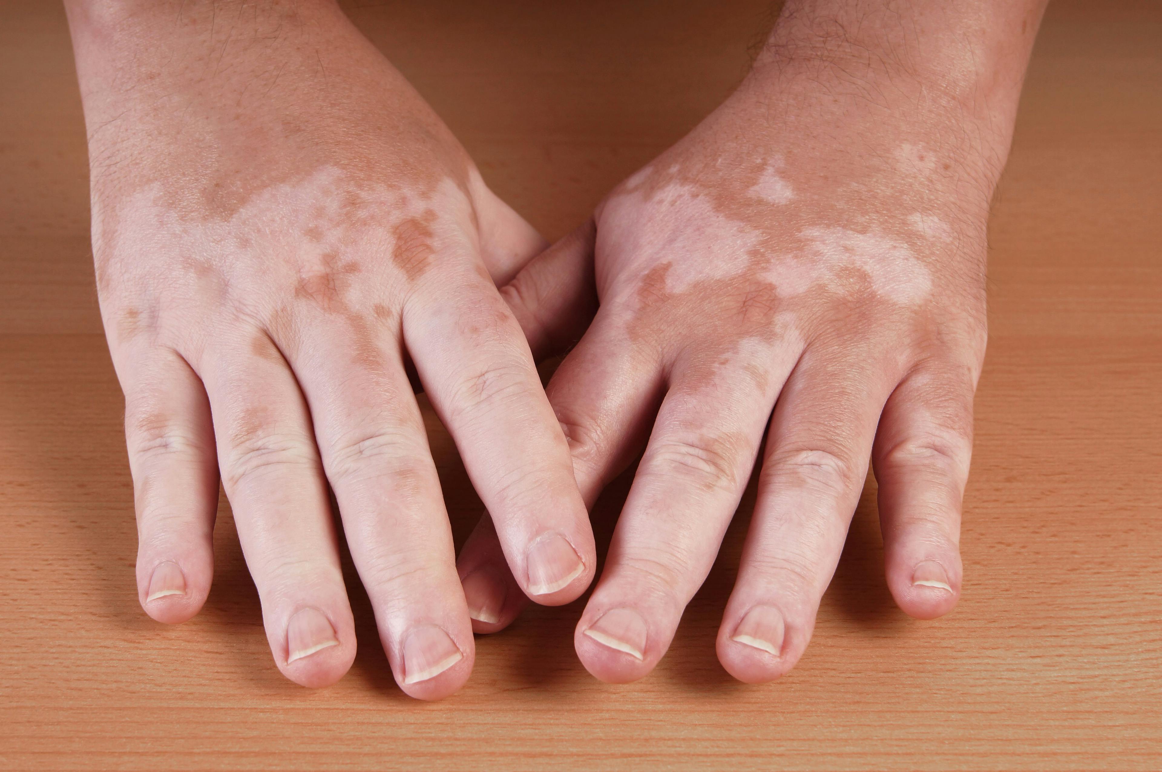 Dermoscopic Monitoring of Vitiligo Lesions Reveal Disease Activity, Evolution Insights