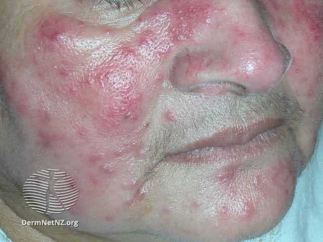 Papulopustular rosacea on the cheeks

Image courtesy of DermNet