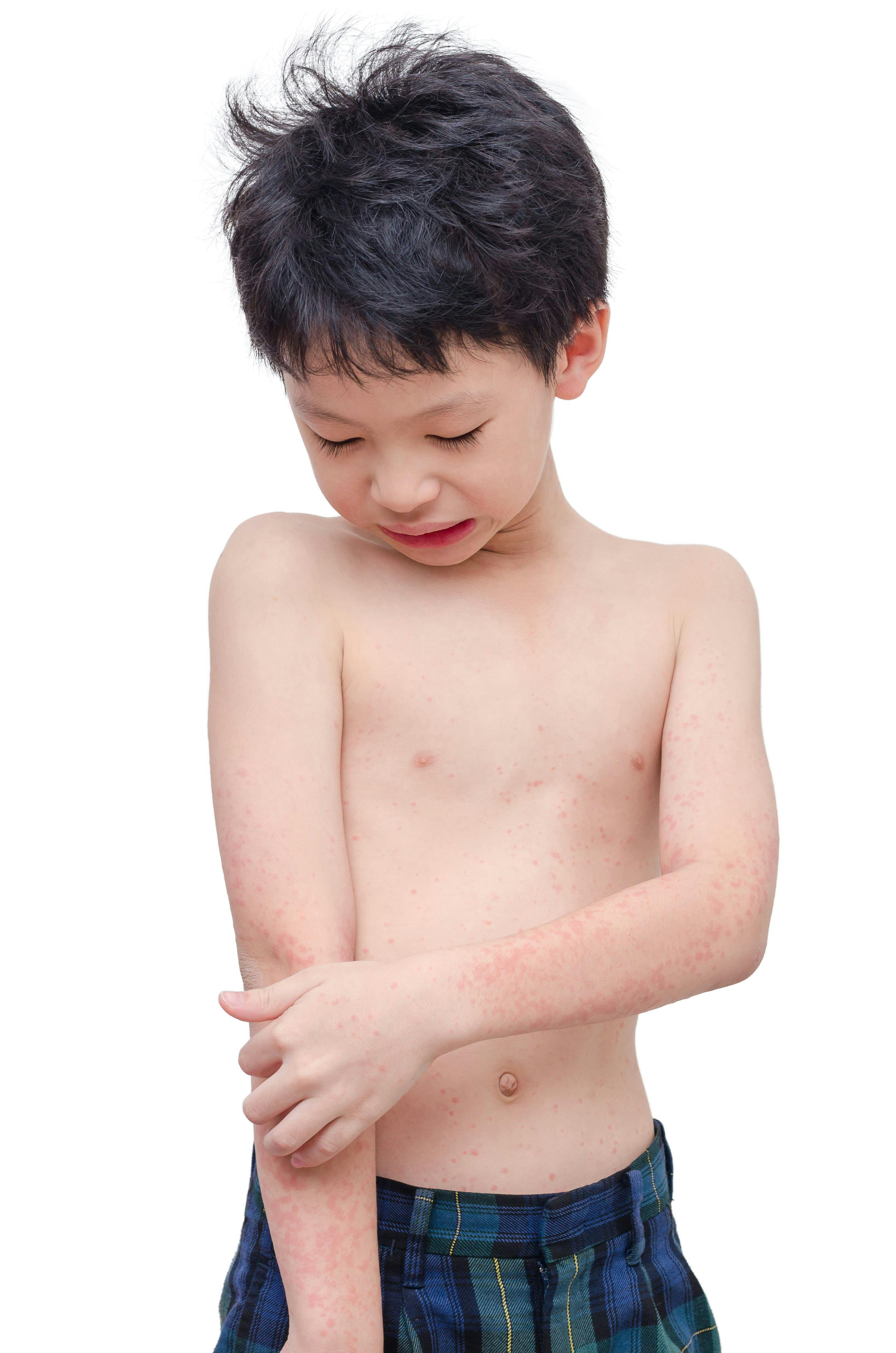 Severity of Atopic Dermatitis Increases Disease Burden