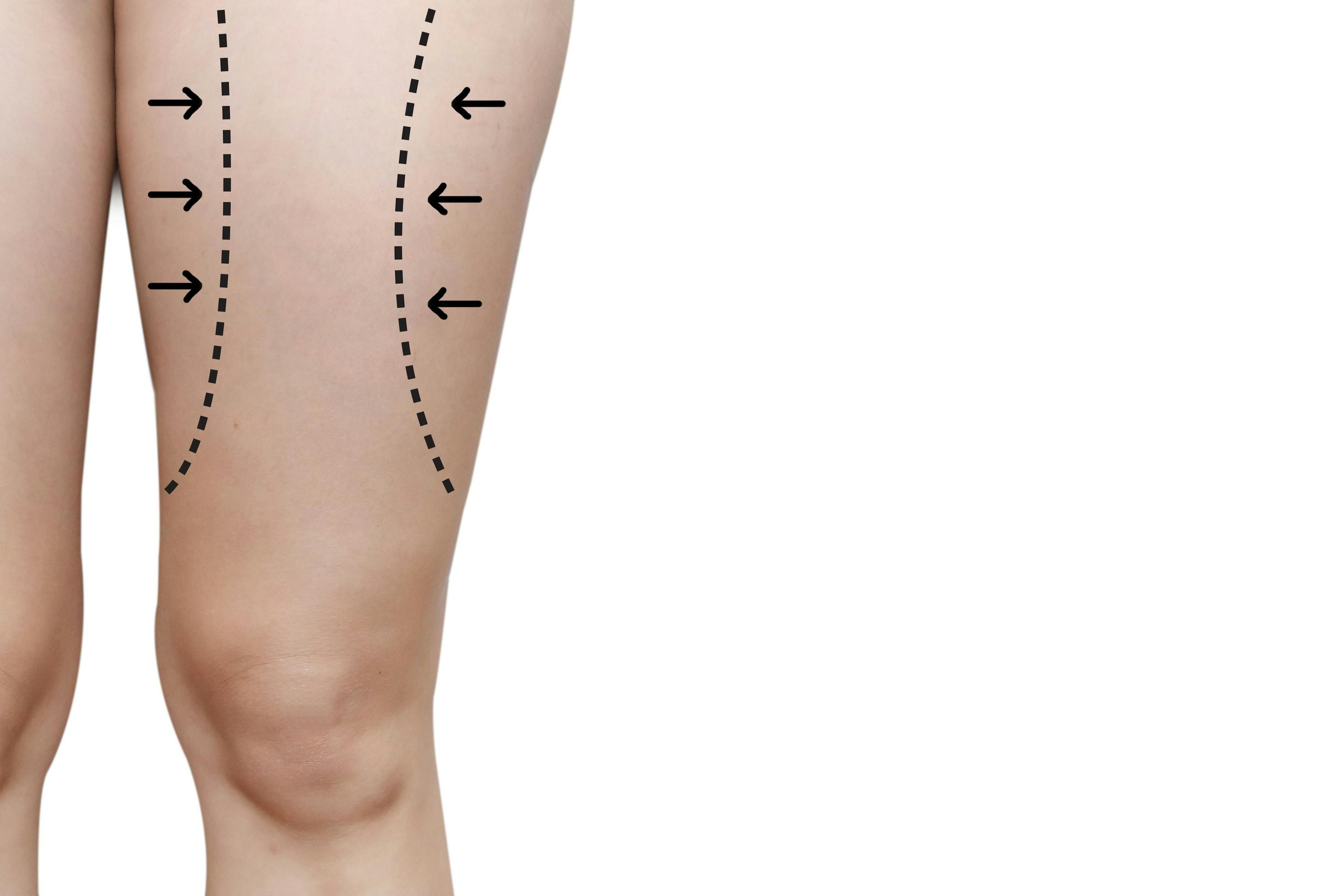 Acoustic Shock Therapy for Cellulite? Maybe. 