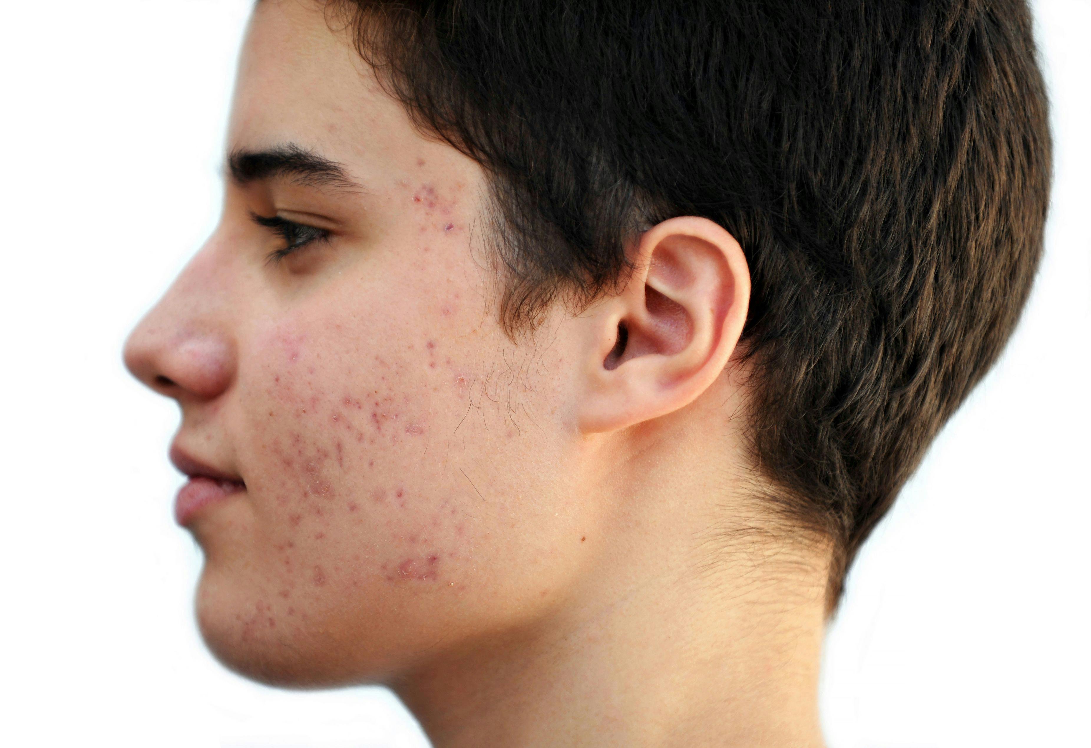 Adolescent acne therapies benefit younger children