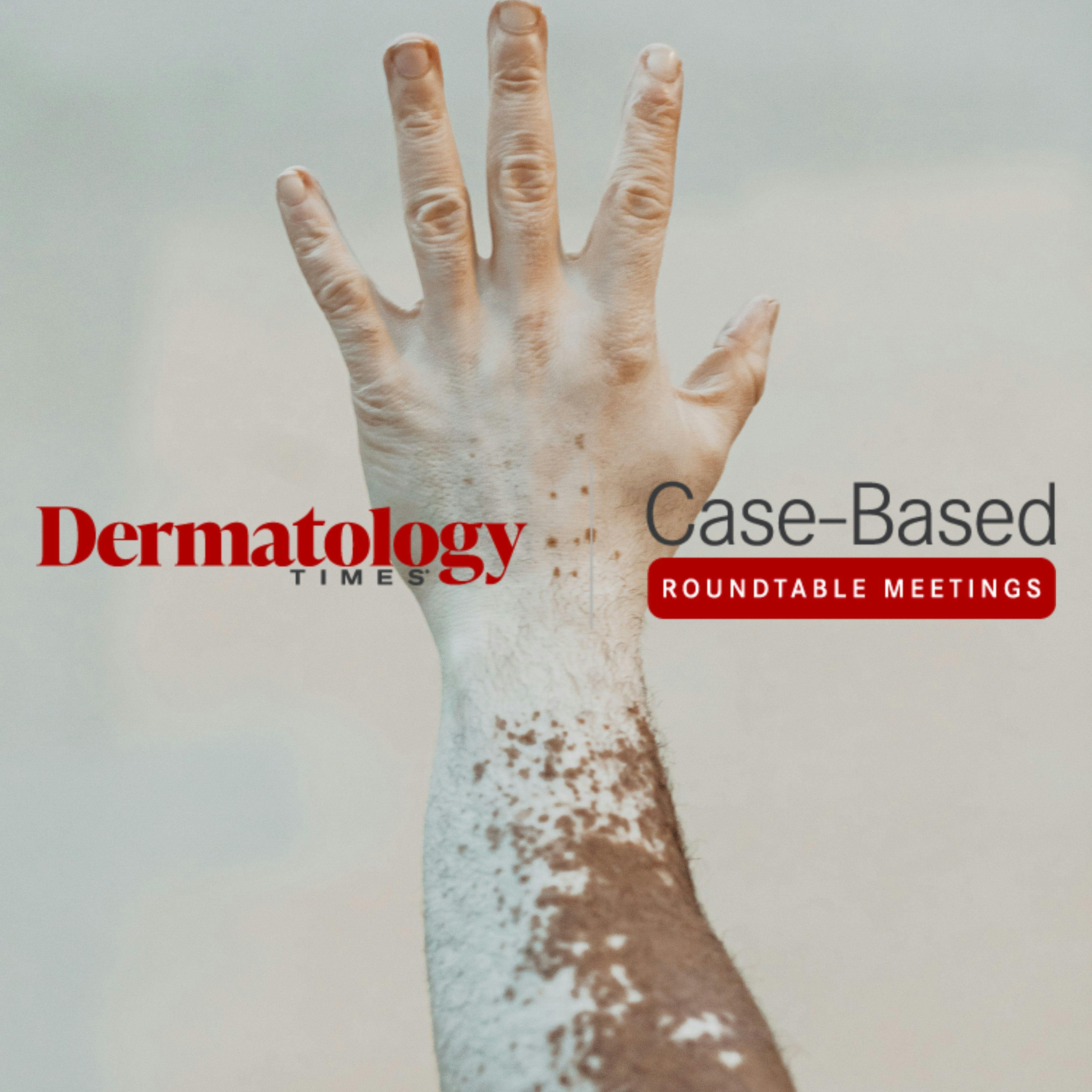 Case Based Roundtables Part 2: Valorizing Topical Treatment Options for Patients With Vitiligo