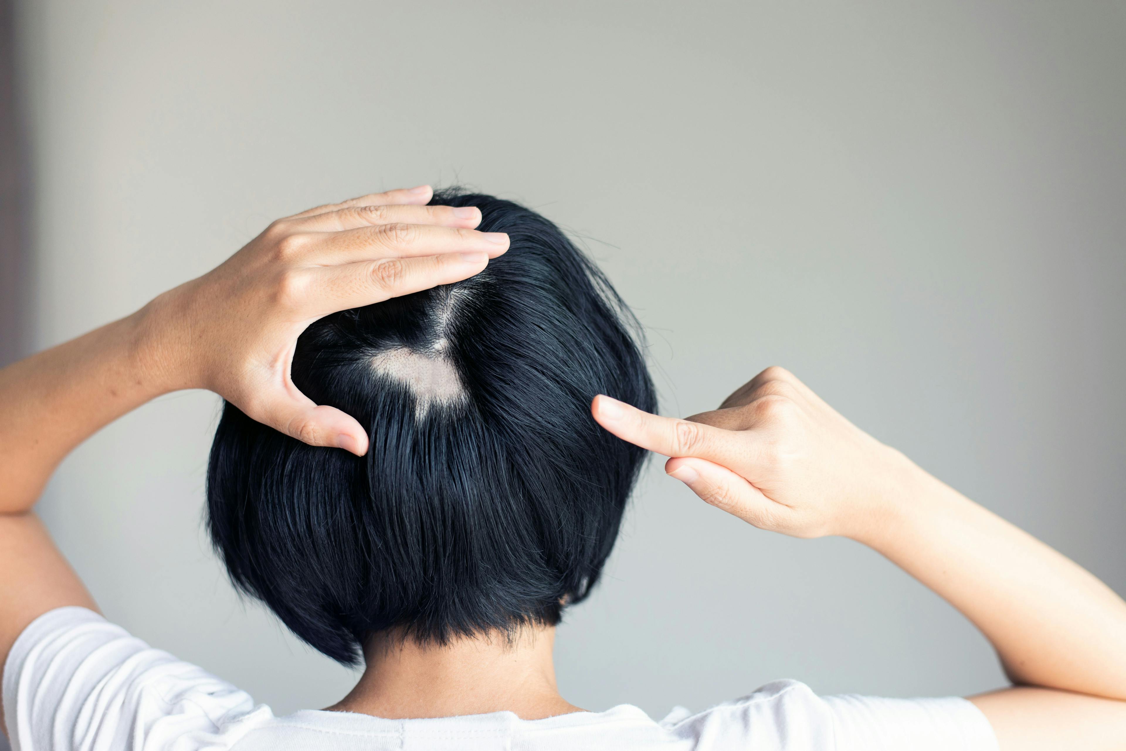 Japanese Study Finds Patients With Alopecia Areata and Physicians Differ in Viewpoints of Severity and Treatment Satisfaction