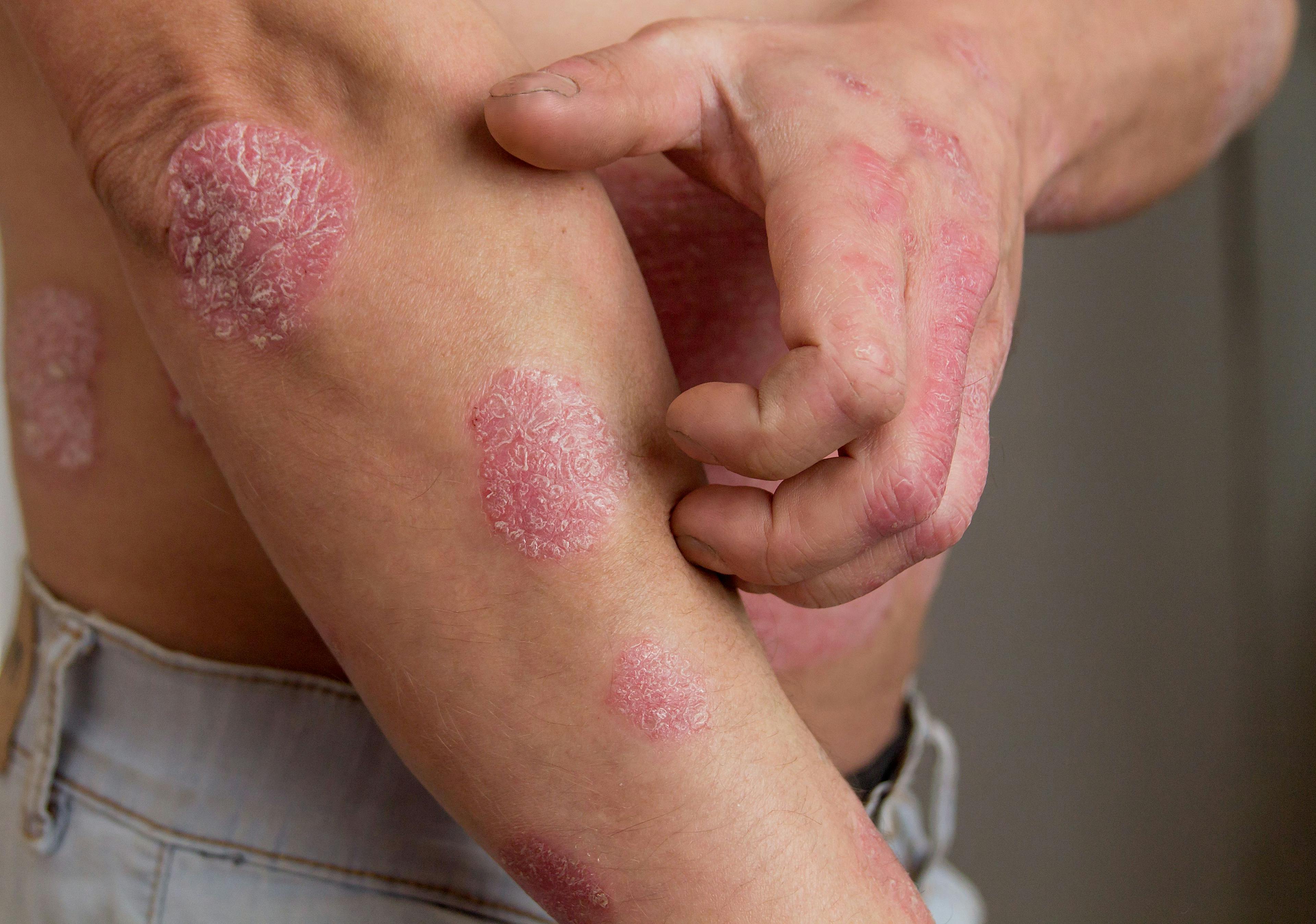 Study: Psoriasis and Colorectal Cancer Association