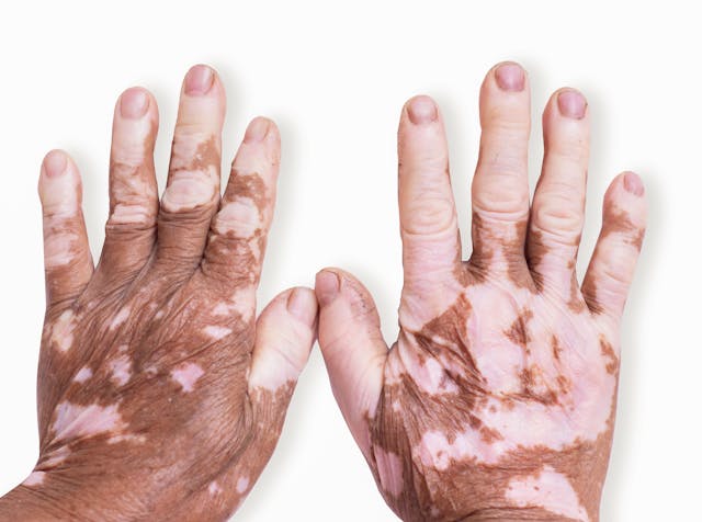 QUIZ: What Should a Patient With Vitiligo Avoid When Concerned About Flares?  