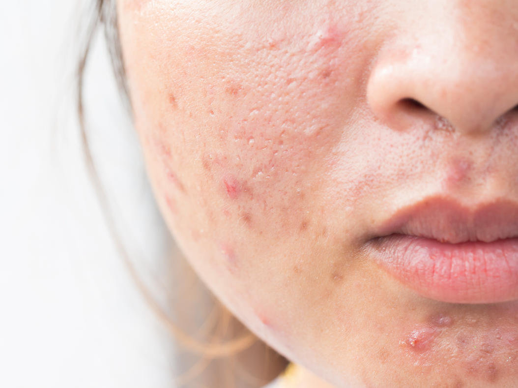 close up of woman's cheek and chin with acne pustules and papules