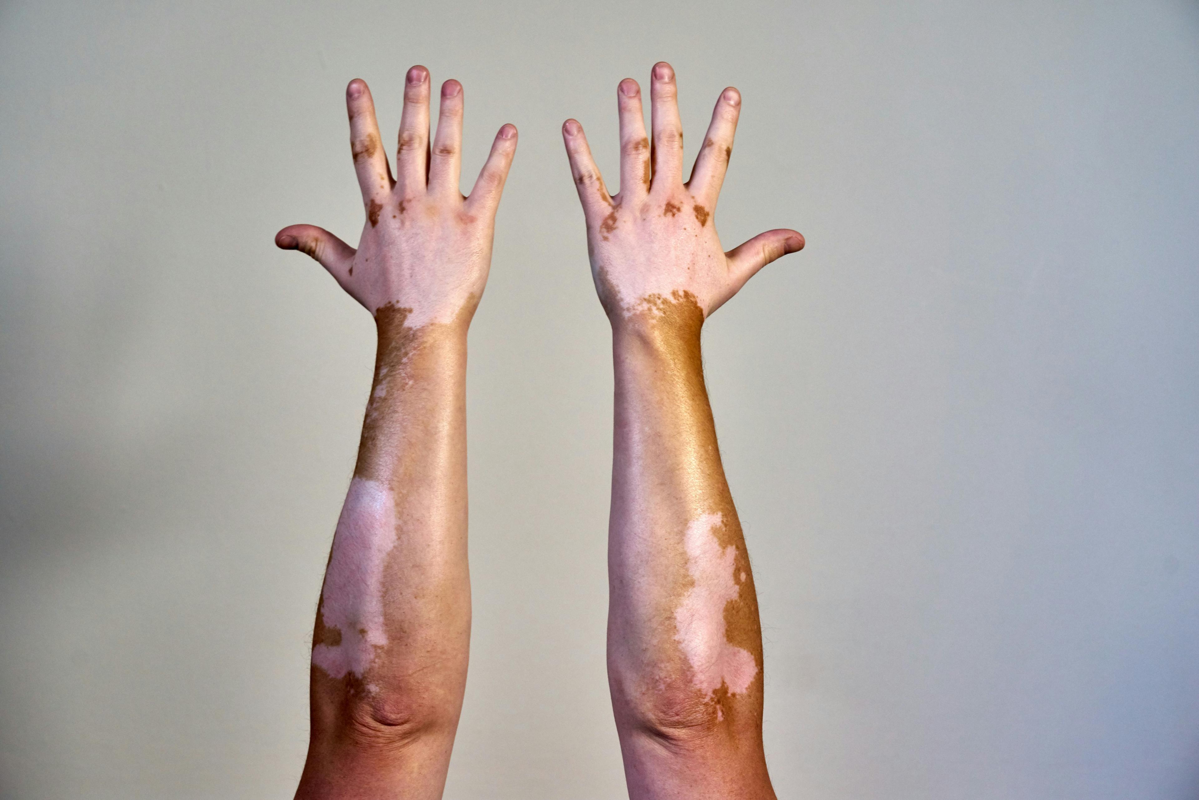 Vitiligo Repigmentation Improvements More Noticeable in Patient-Reported Outcome Measures