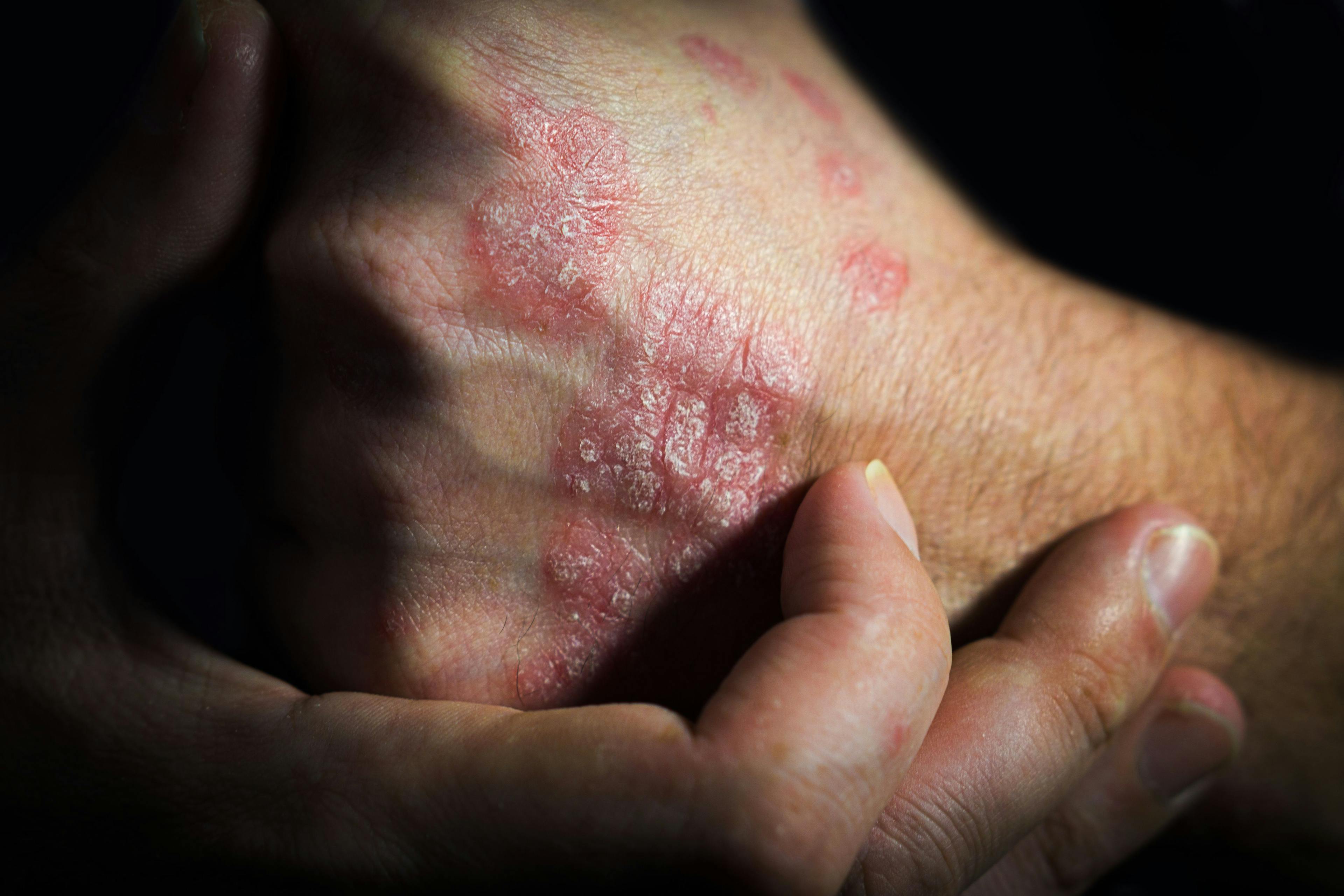 JAMA Publishes Roflumilast Cream Phase 3 Trial Results for Plaque Psoriasis  