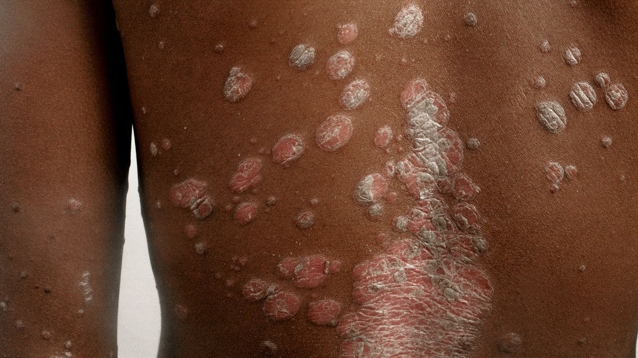 Psoriasis on skin of color patient