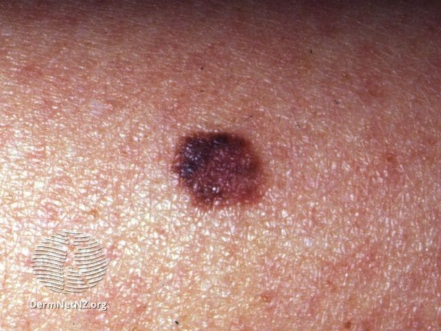 Superficial spreading melanoma

Image courtesy of DermNet