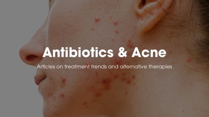 Top 5 stories on antibiotics and acne