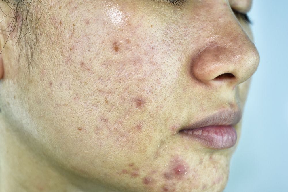 Natural extracts outweigh synthetic antibiotics for acne treatment