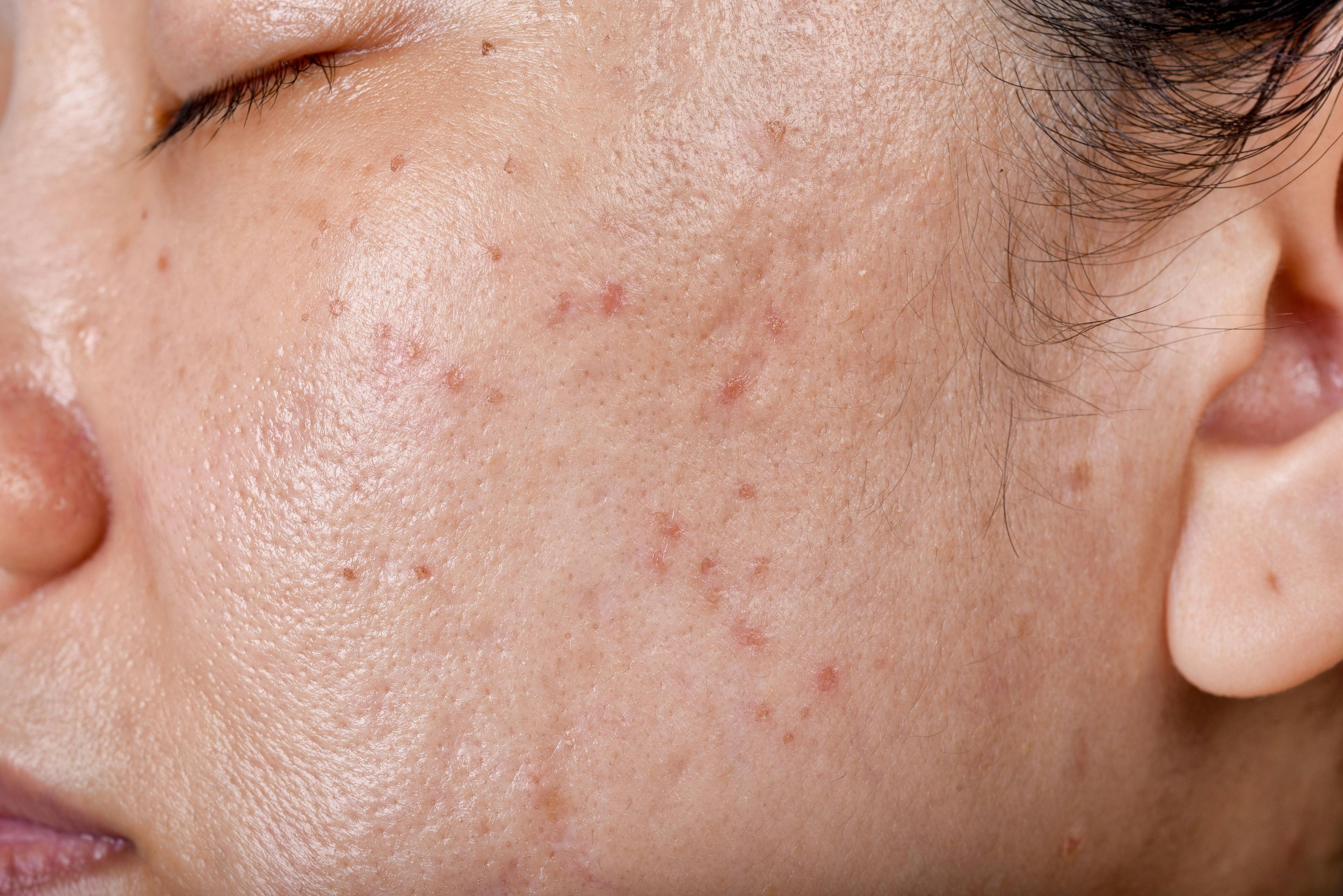 Microneedling Produces Beneficial Acne Vulgaris Outcomes Without Disrupting Skin Structure or Microbiome