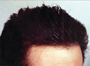 Hair transplantation before and after six FUT surgeries 