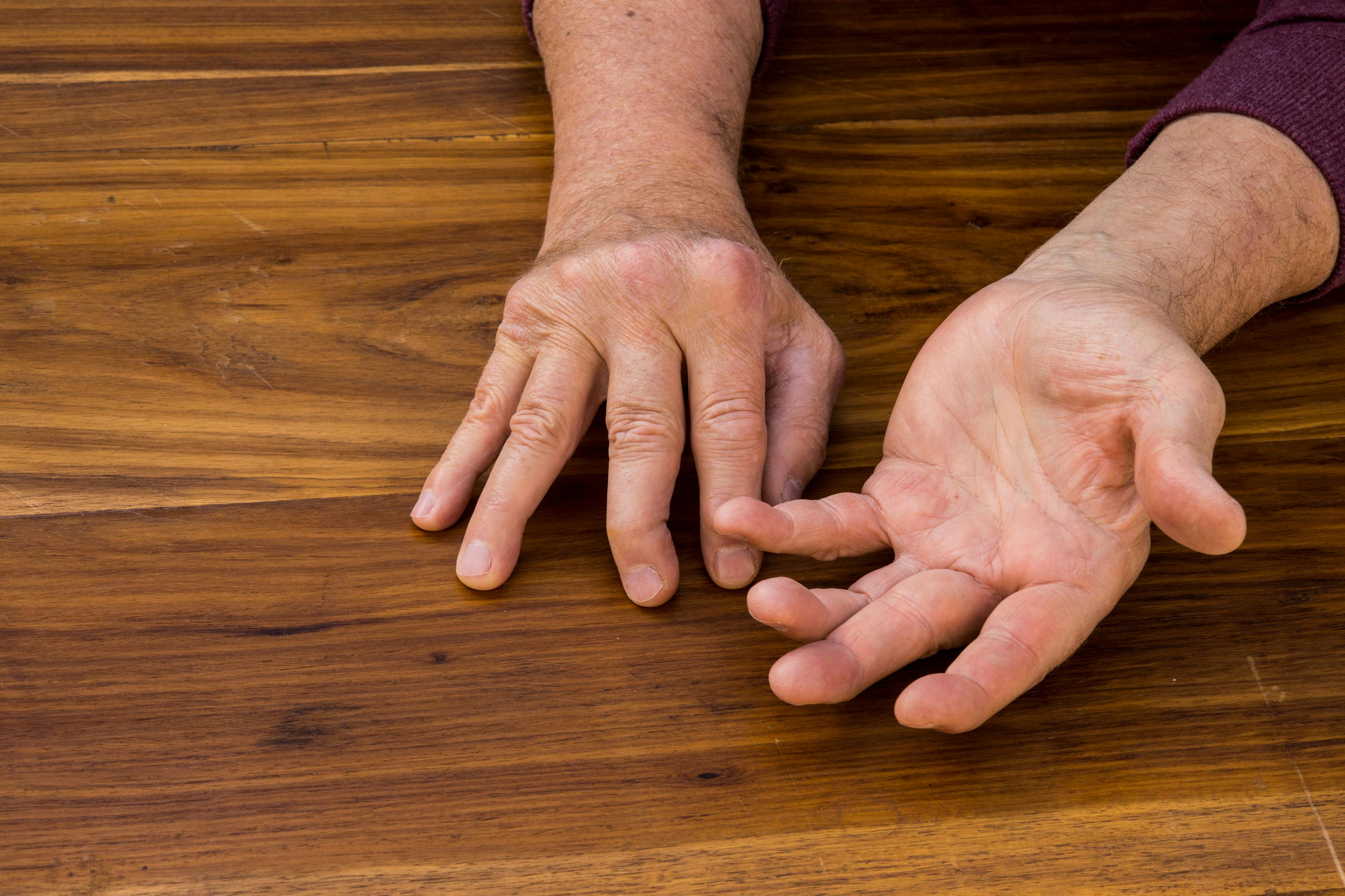 Izokibep Demonstrates Statistically Significant Improvements in Psoriatic Arthritis